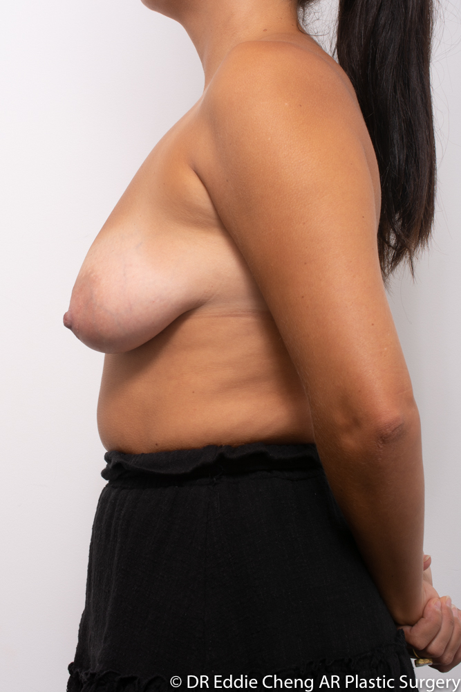 Breast-Reduction-PRE-OP-Dr_Eddie_Cheng_Specialist_Plastic_Surgeon_Brisbane-005