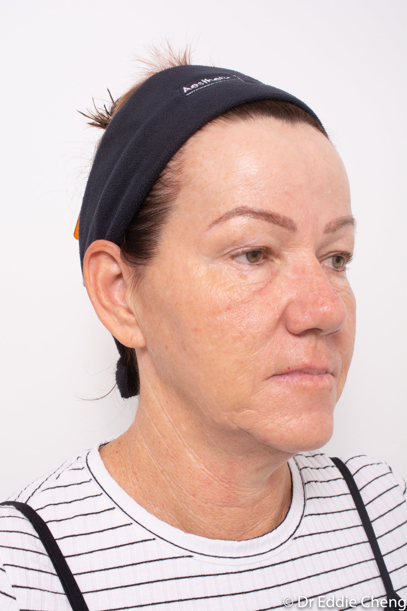 Brow lift dr eddie cheng blepharoplasty pre and post operative brisbane surgeon -2-2