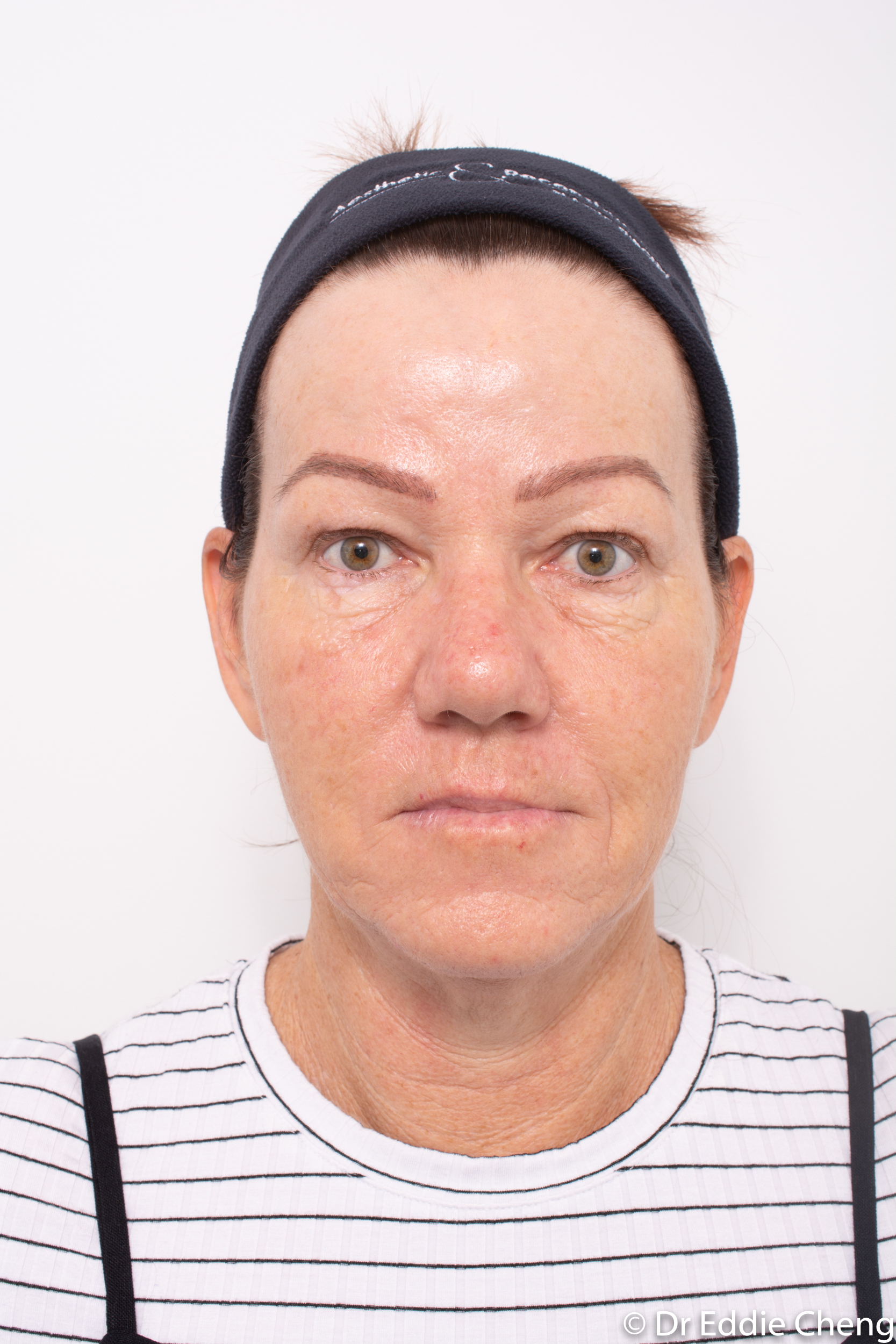 Brow lift dr eddie cheng blepharoplasty pre and post operative brisbane surgeon -3-2