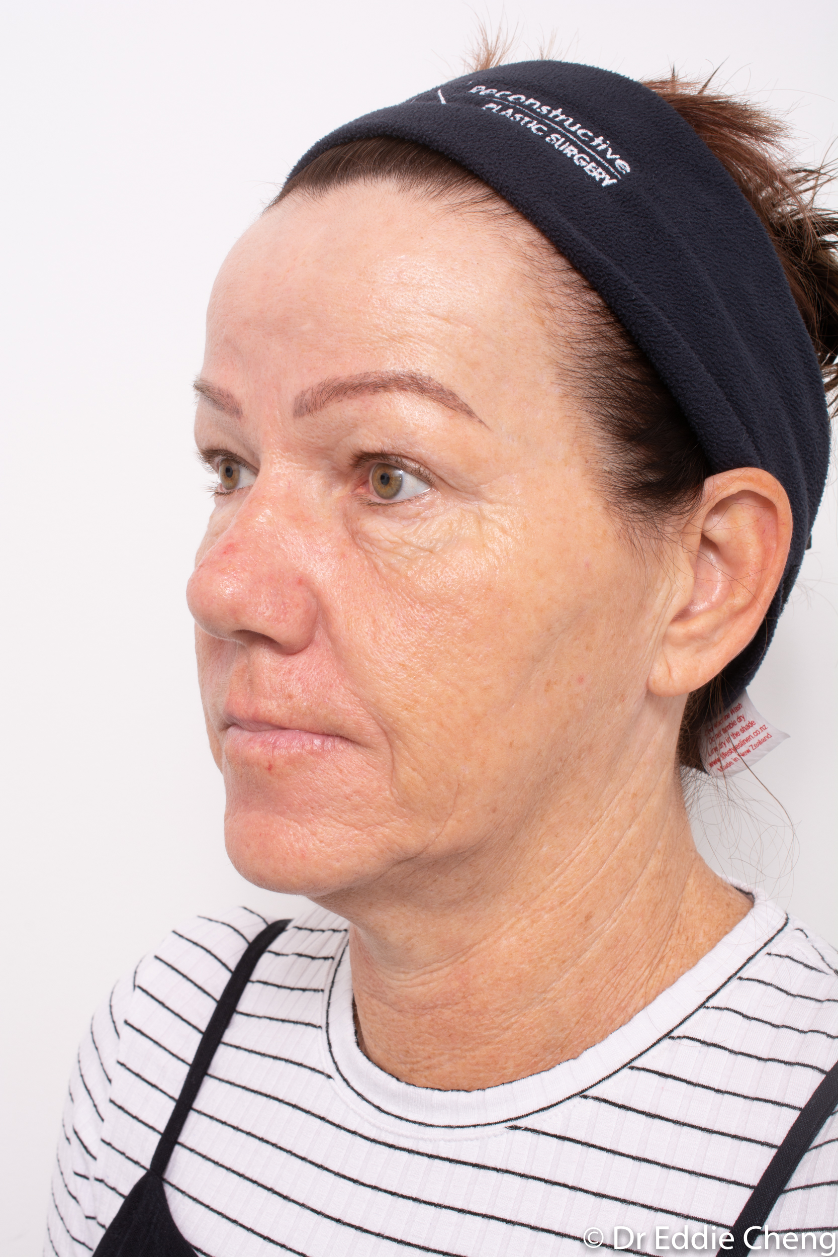 Brow lift dr eddie cheng blepharoplasty pre and post operative brisbane surgeon -4-2