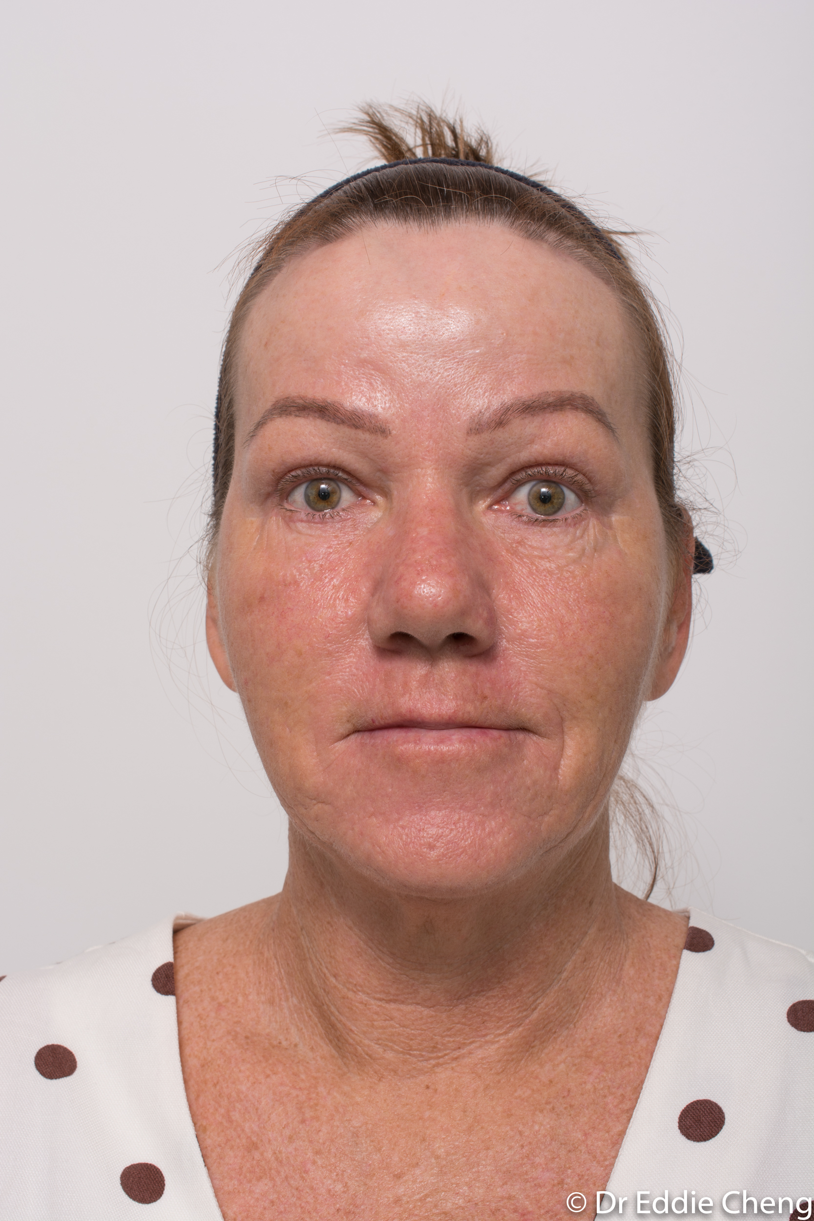 Brow lift dr eddie cheng blepharoplasty pre and post operative brisbane surgeon -6-2