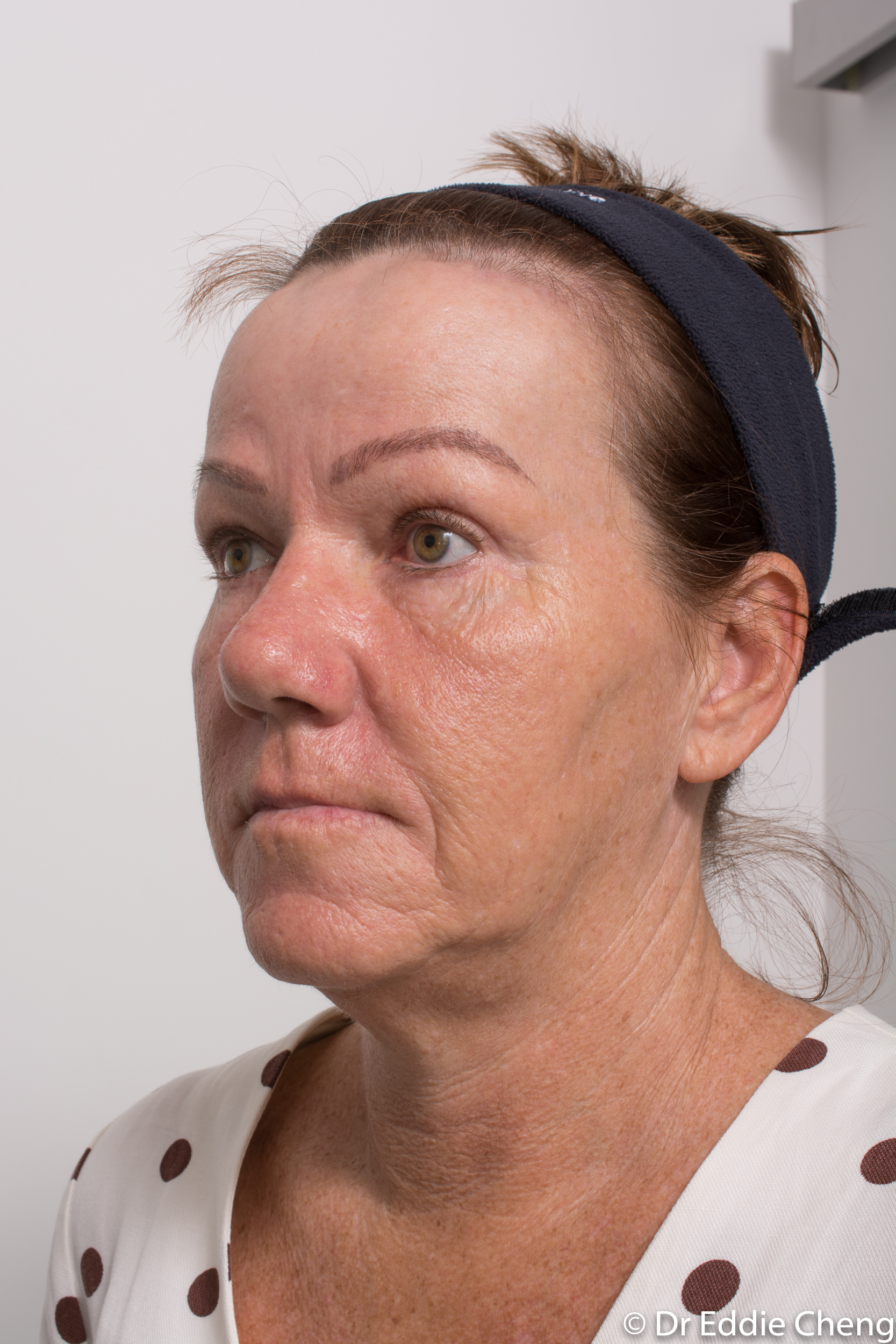 Brow lift dr eddie cheng blepharoplasty pre and post operative brisbane surgeon -7-2