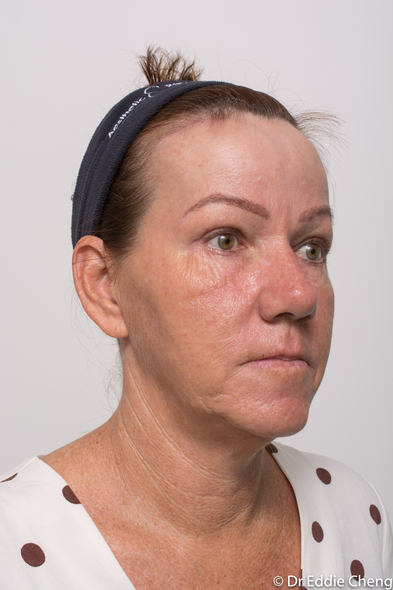 Brow lift dr eddie cheng blepharoplasty pre and post operative brisbane surgeon -9-2