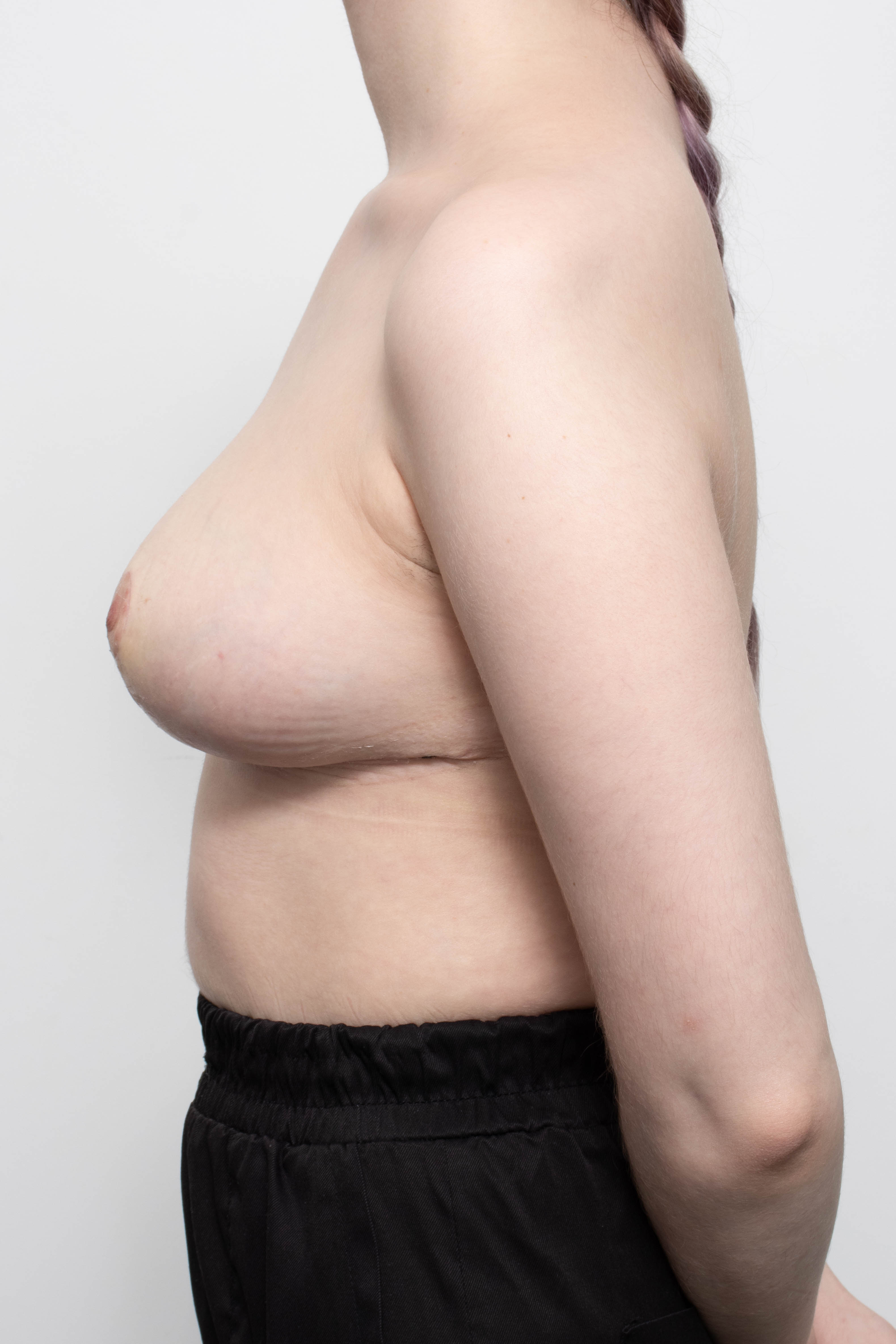 POST OP BREAST REDUCTION, BRISBANE, DR EDDIE CHENG-5