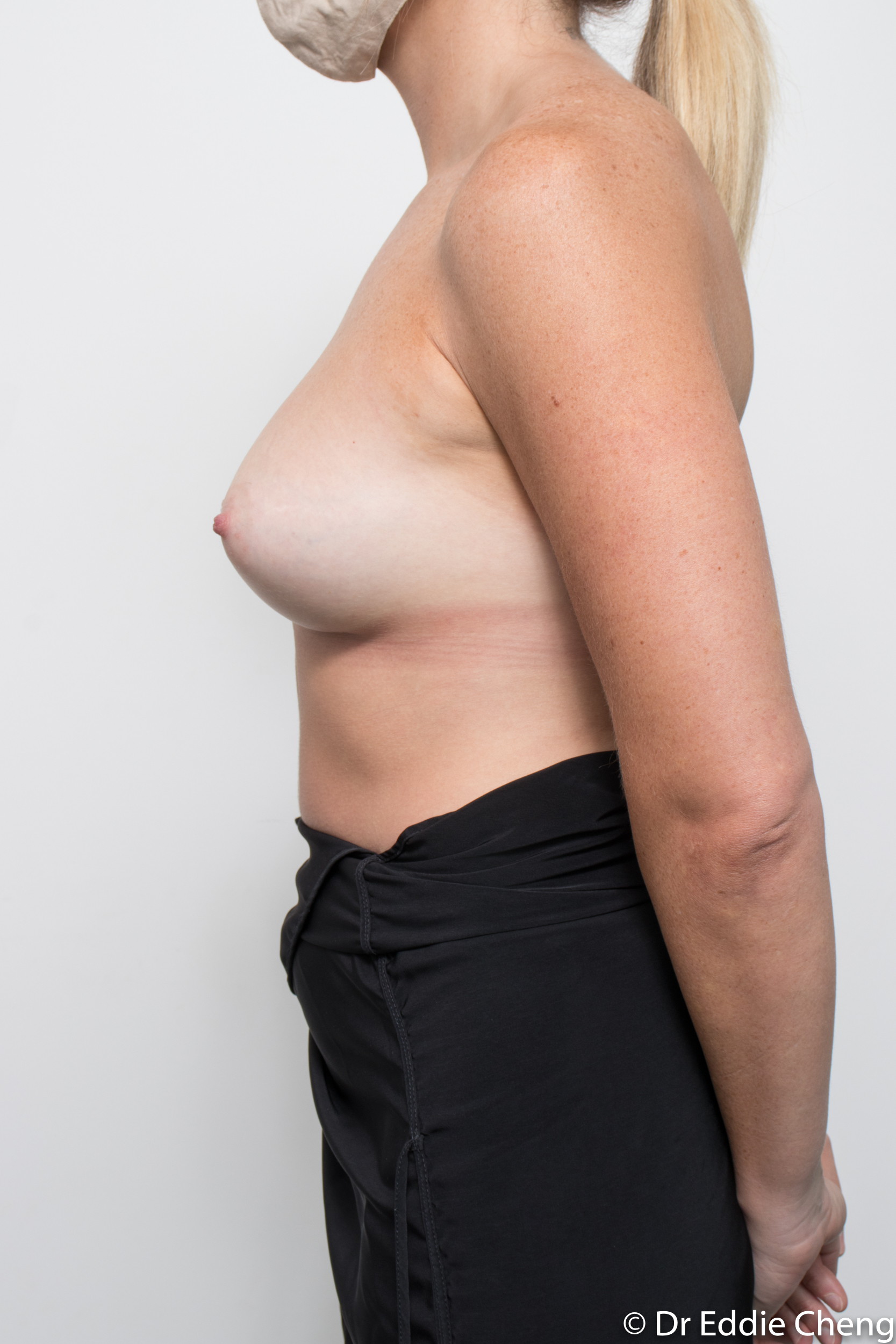 Post op Breast Augmentation dr eddiecheng brisbane-5