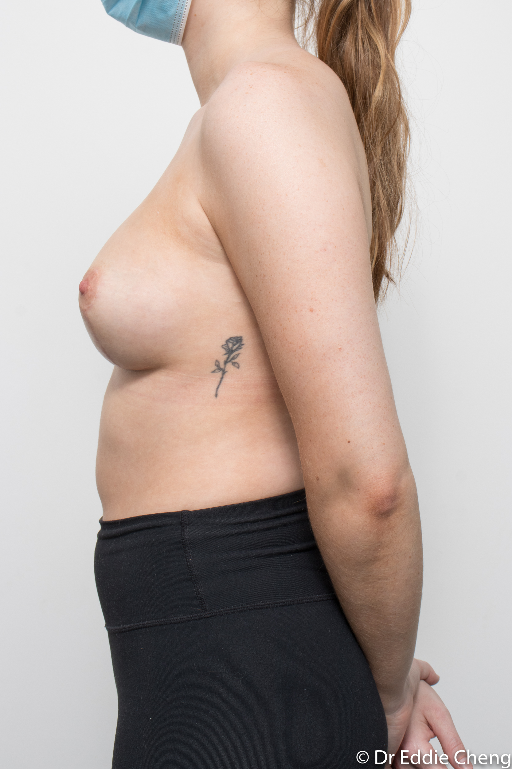 Post op Tuberous breast dr eddiecheng brisbane-5