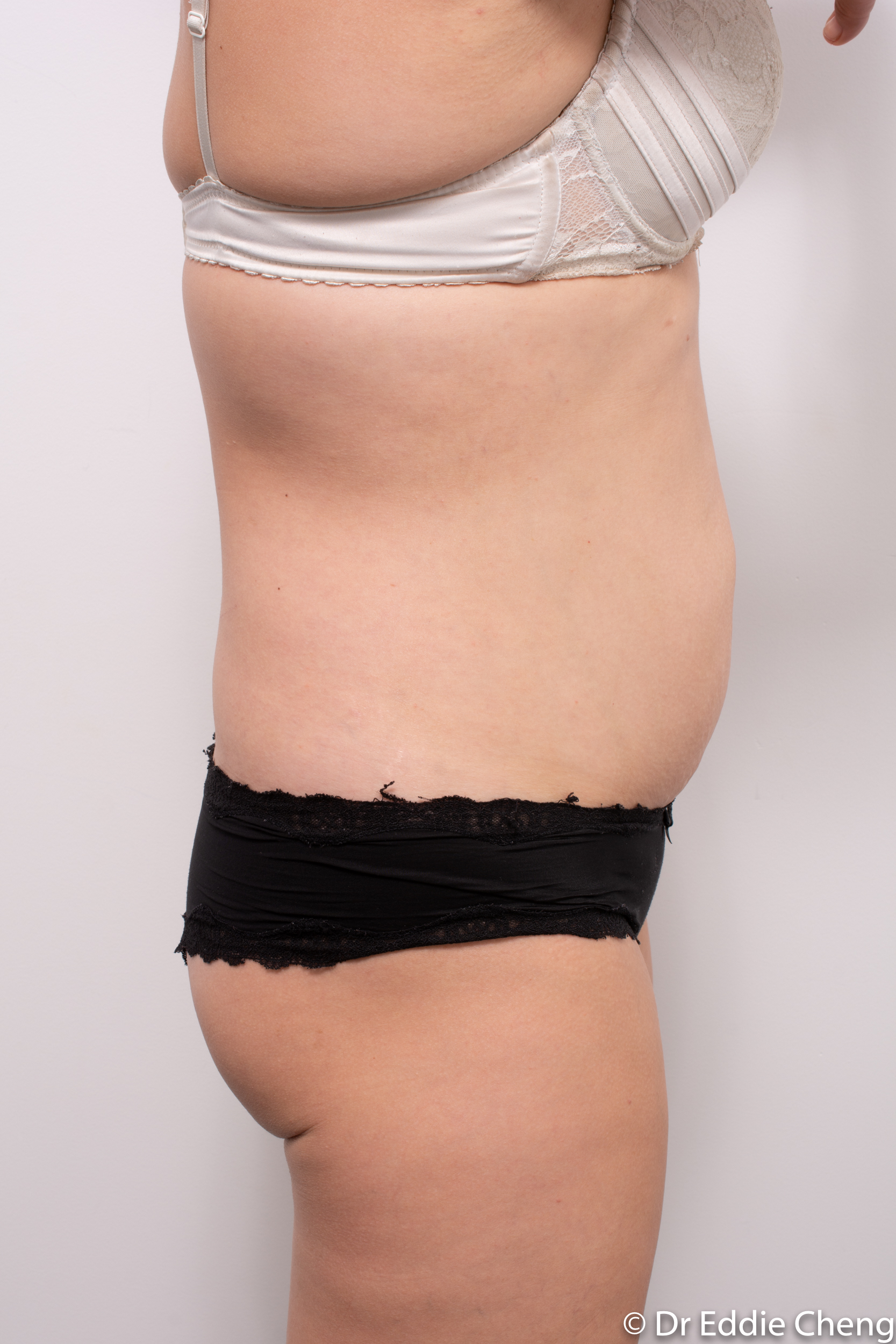 abdominoplasty liposuction dr eddie cheng brisbane-1