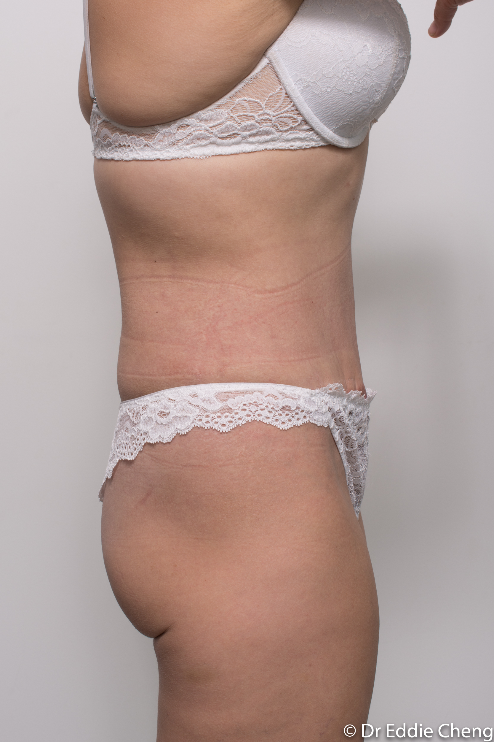 abdominoplasty liposuction dr eddie cheng brisbane-10