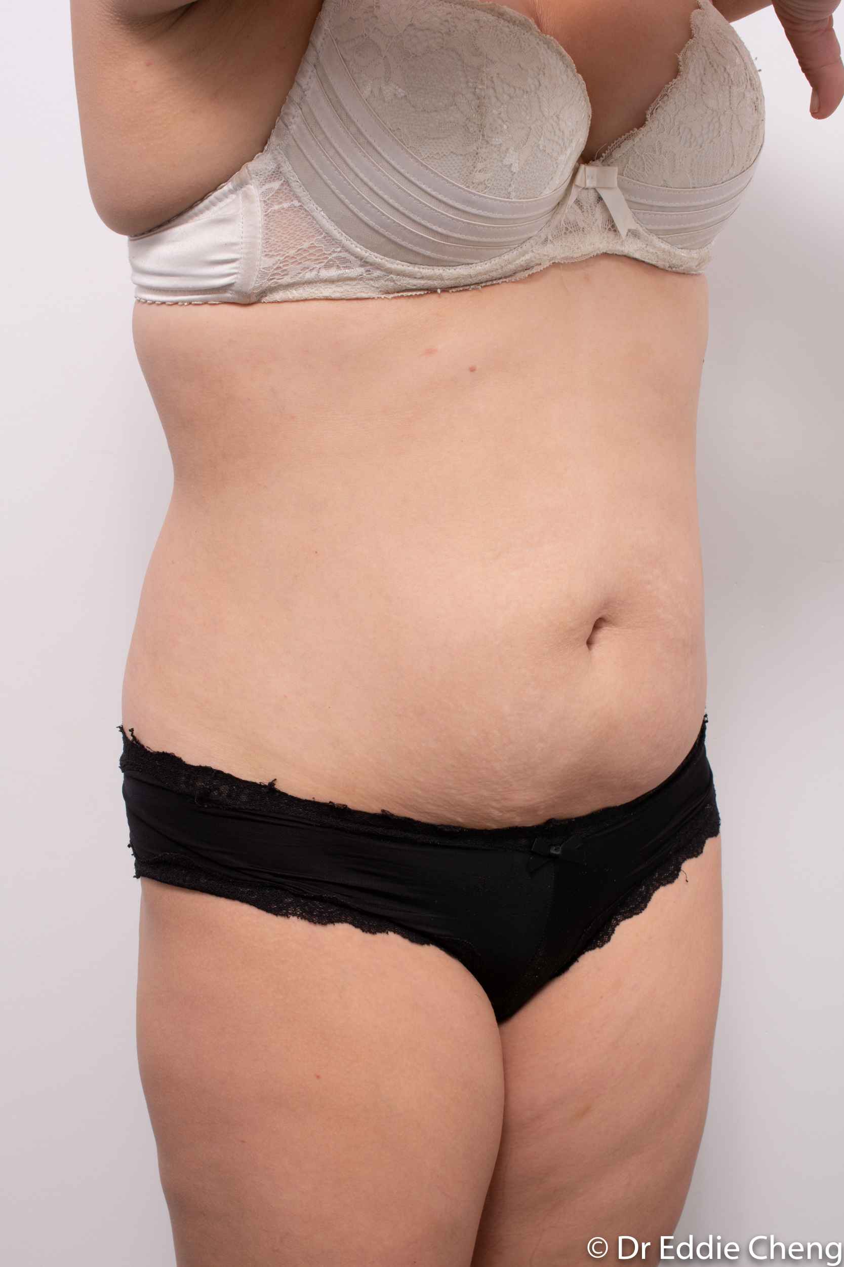 abdominoplasty liposuction dr eddie cheng brisbane-2