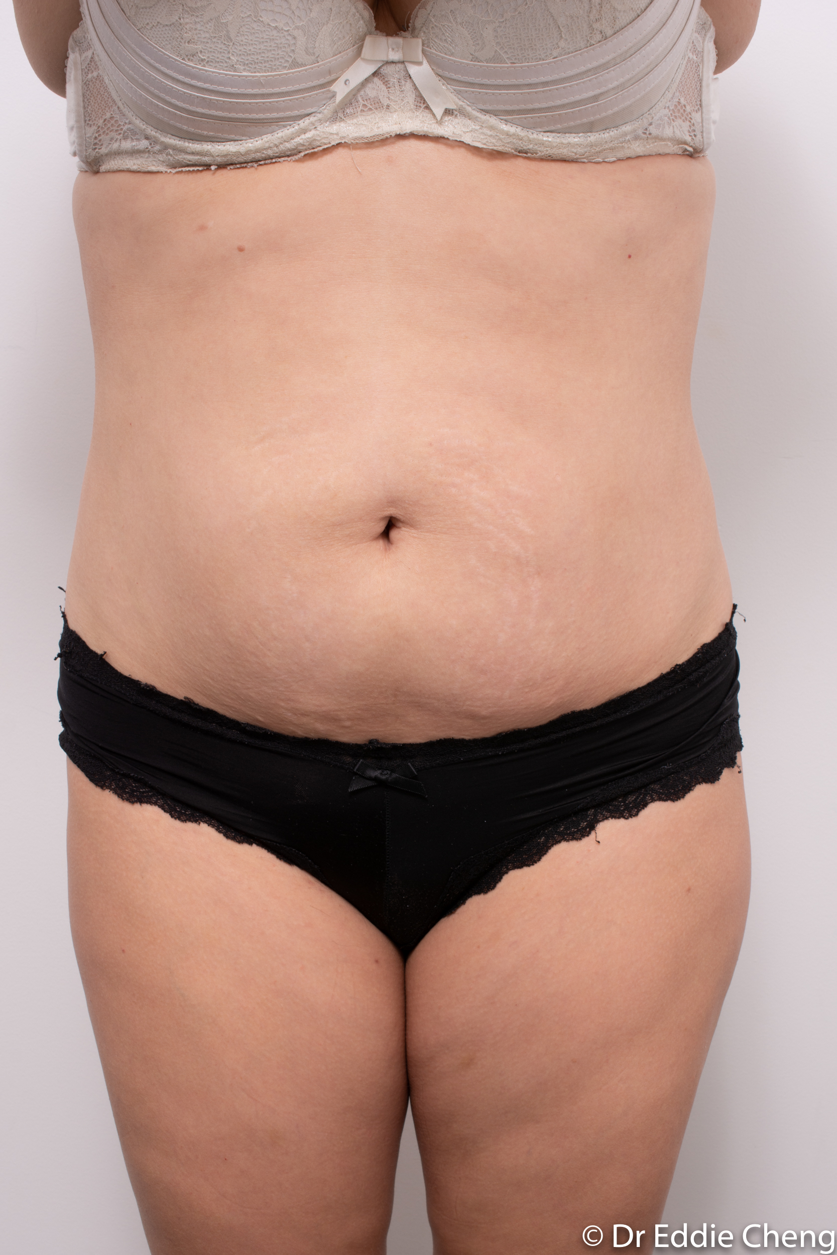 abdominoplasty liposuction dr eddie cheng brisbane-3