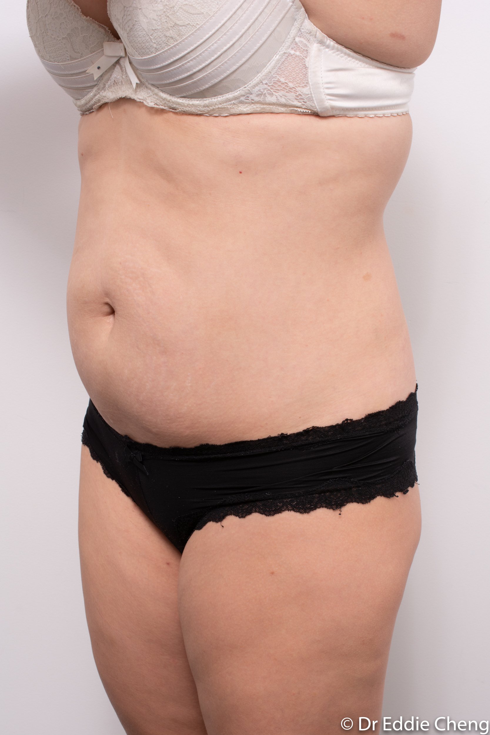 abdominoplasty liposuction dr eddie cheng brisbane-4