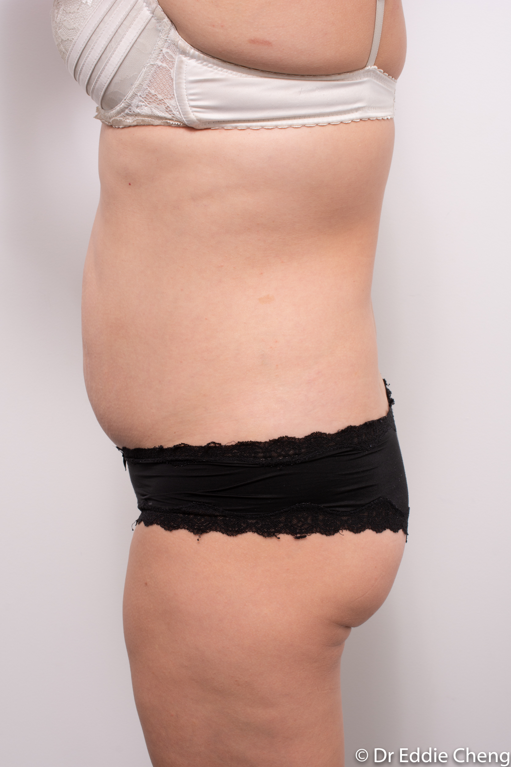 abdominoplasty liposuction dr eddie cheng brisbane-5