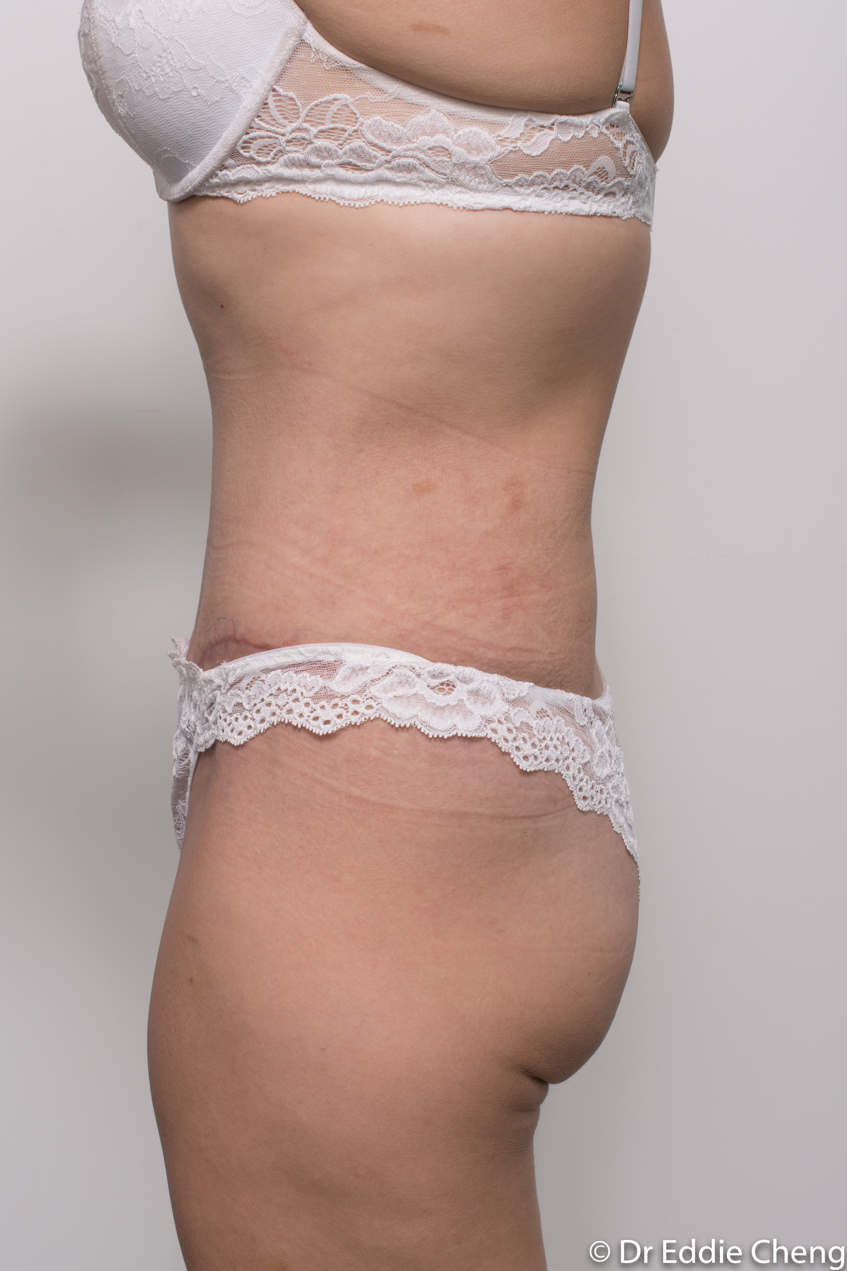 abdominoplasty liposuction dr eddie cheng brisbane-8