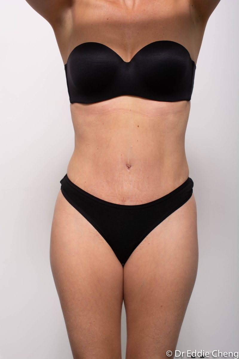 Abdominoplasty