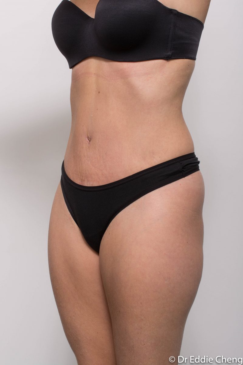 abdominoplasty-post-op-6-weeks-6-52-2-800x1200