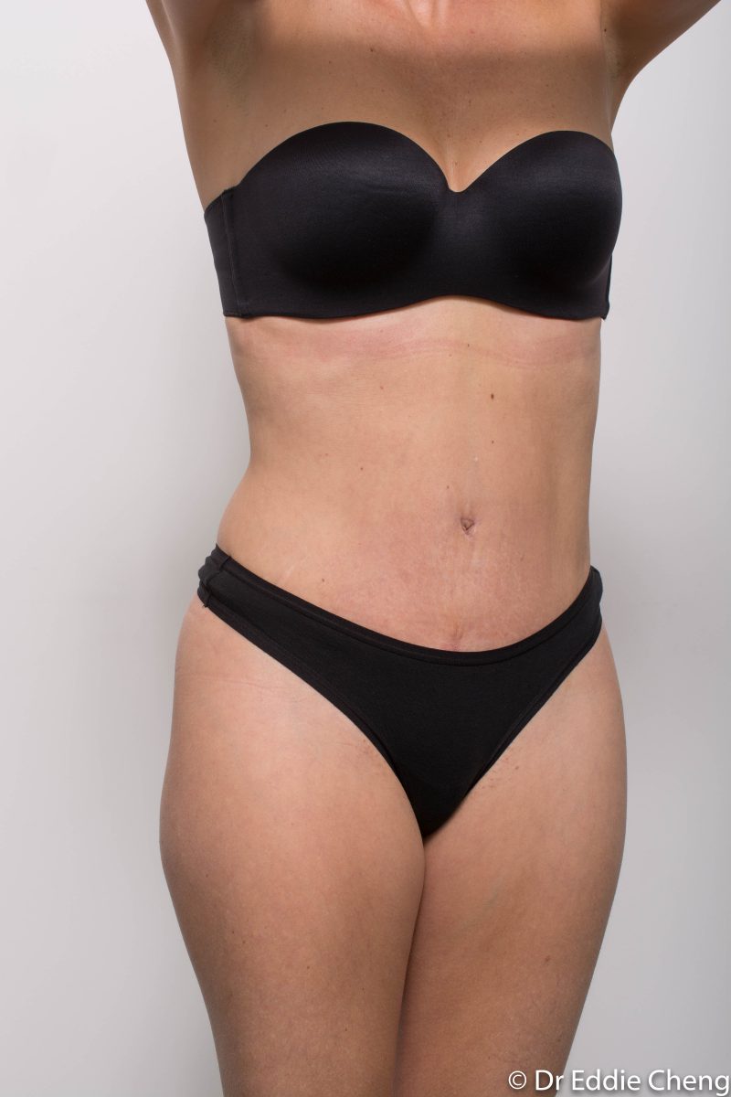 abdominoplasty-post-op-6-weeks-6-52-4-800x1200