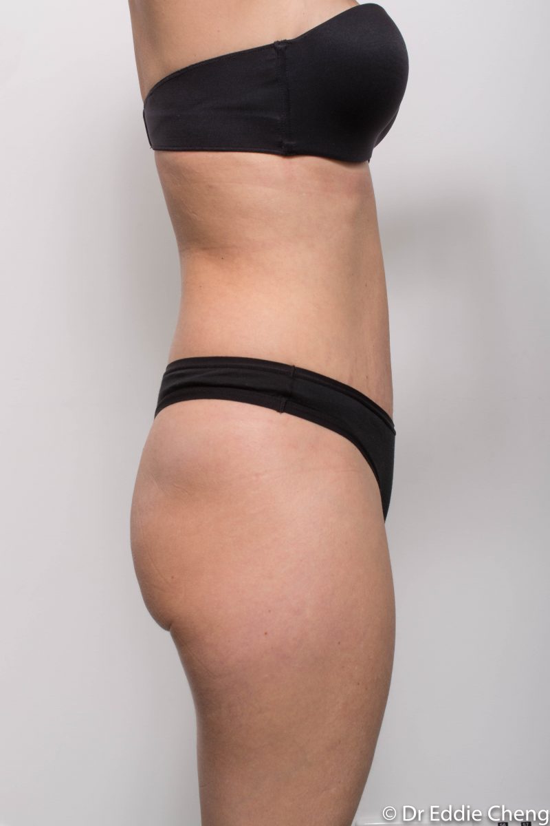 abdominoplasty-post-op-6-weeks-6-52-5-800x1200