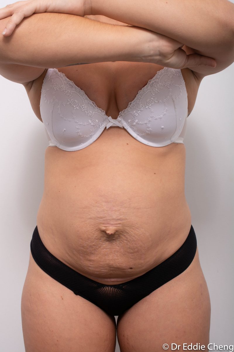 Abdominoplasty