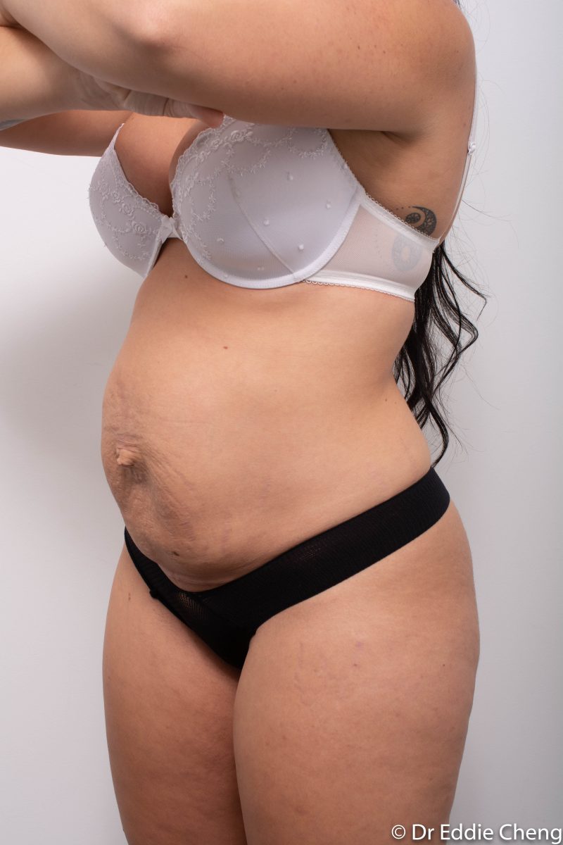 abdominoplasty-pre-op-4-800x1200