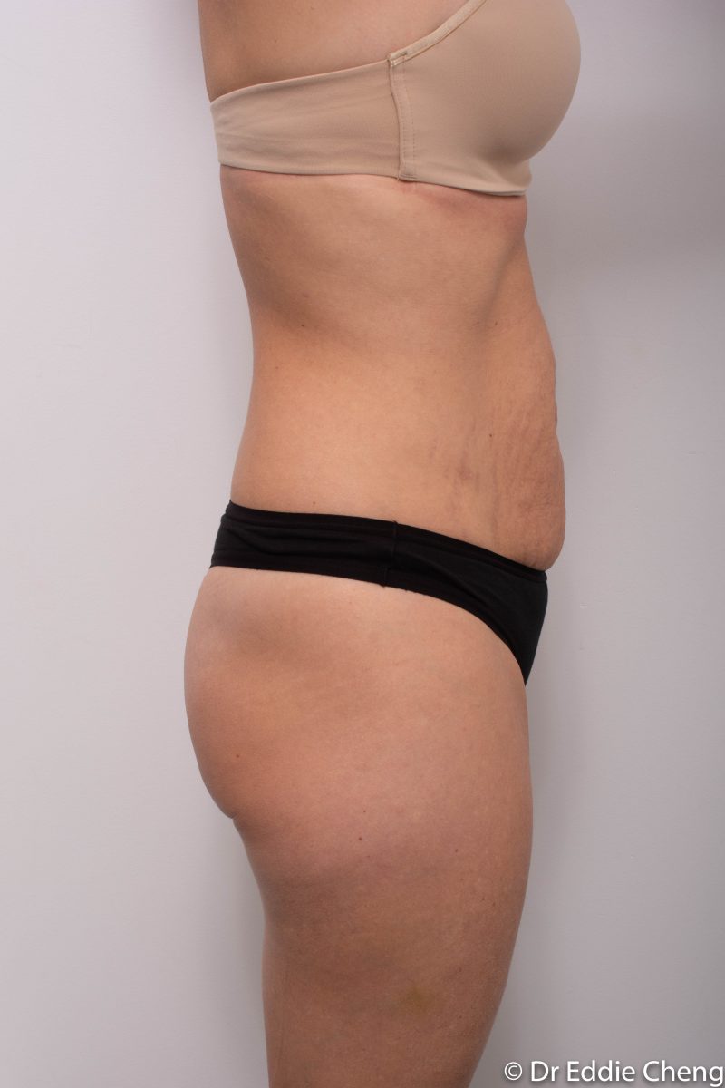 abdominoplasty-pre-op-tummy-tuck-1-800x1200