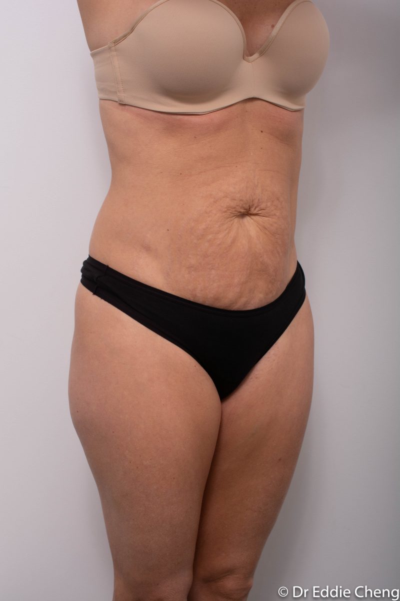 abdominoplasty-pre-op-tummy-tuck-2-800x1200