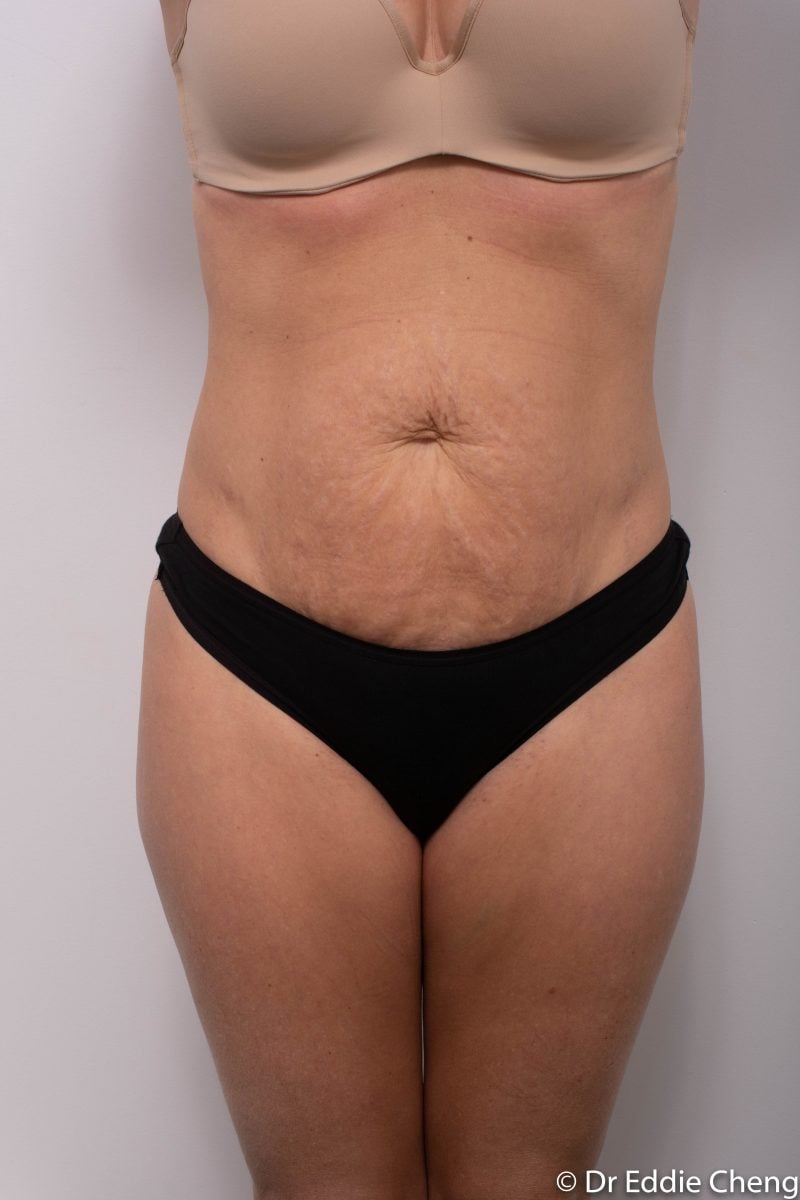 Abdominoplasty