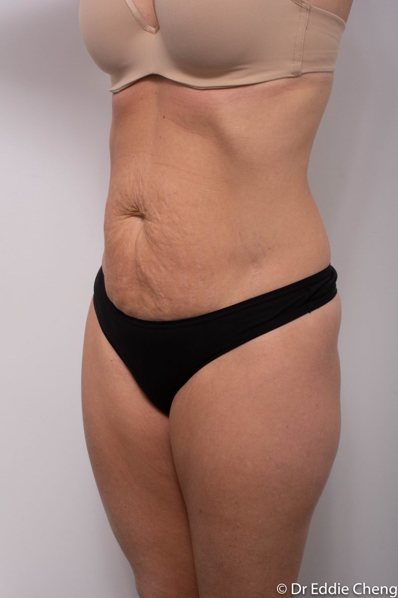 abdominoplasty-pre-op-tummy-tuck-4-800x1200