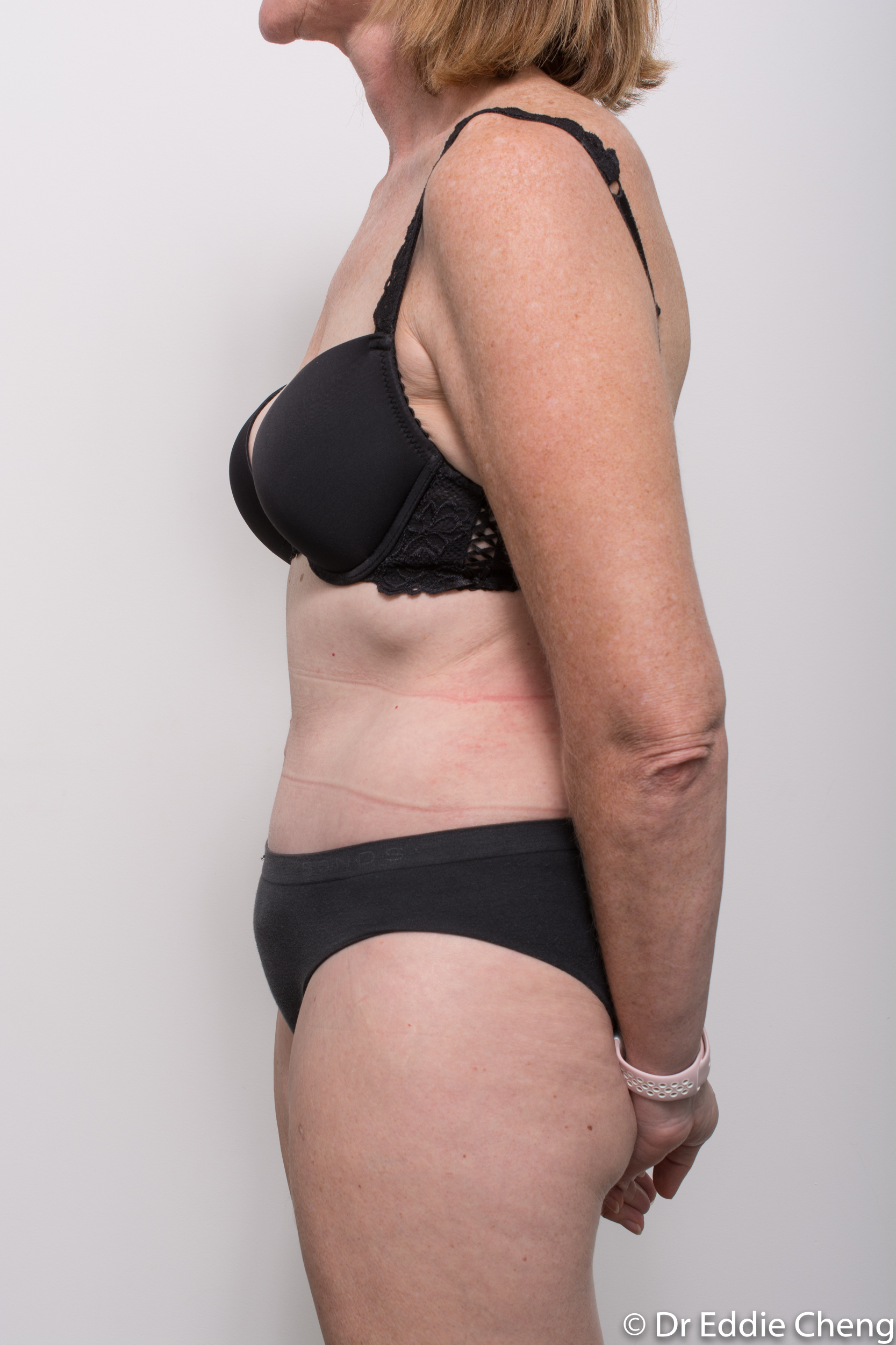 before and after abdominoplasty dr eddie cheng brisbane-10