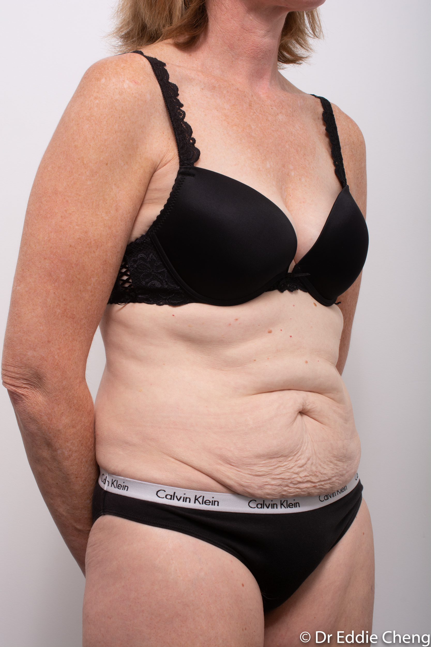 before and after abdominoplasty dr eddie cheng brisbane-2