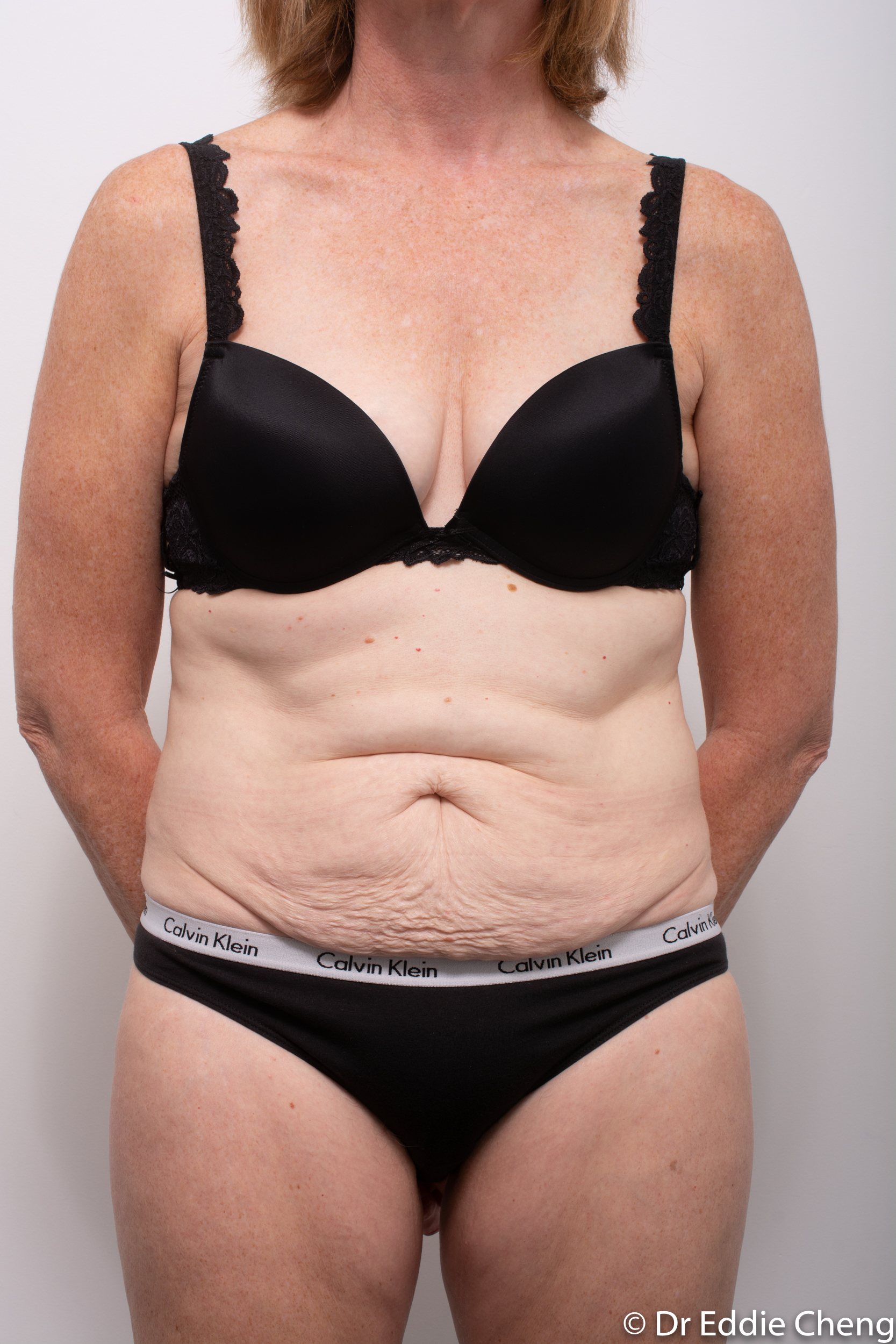 before and after abdominoplasty dr eddie cheng brisbane-3