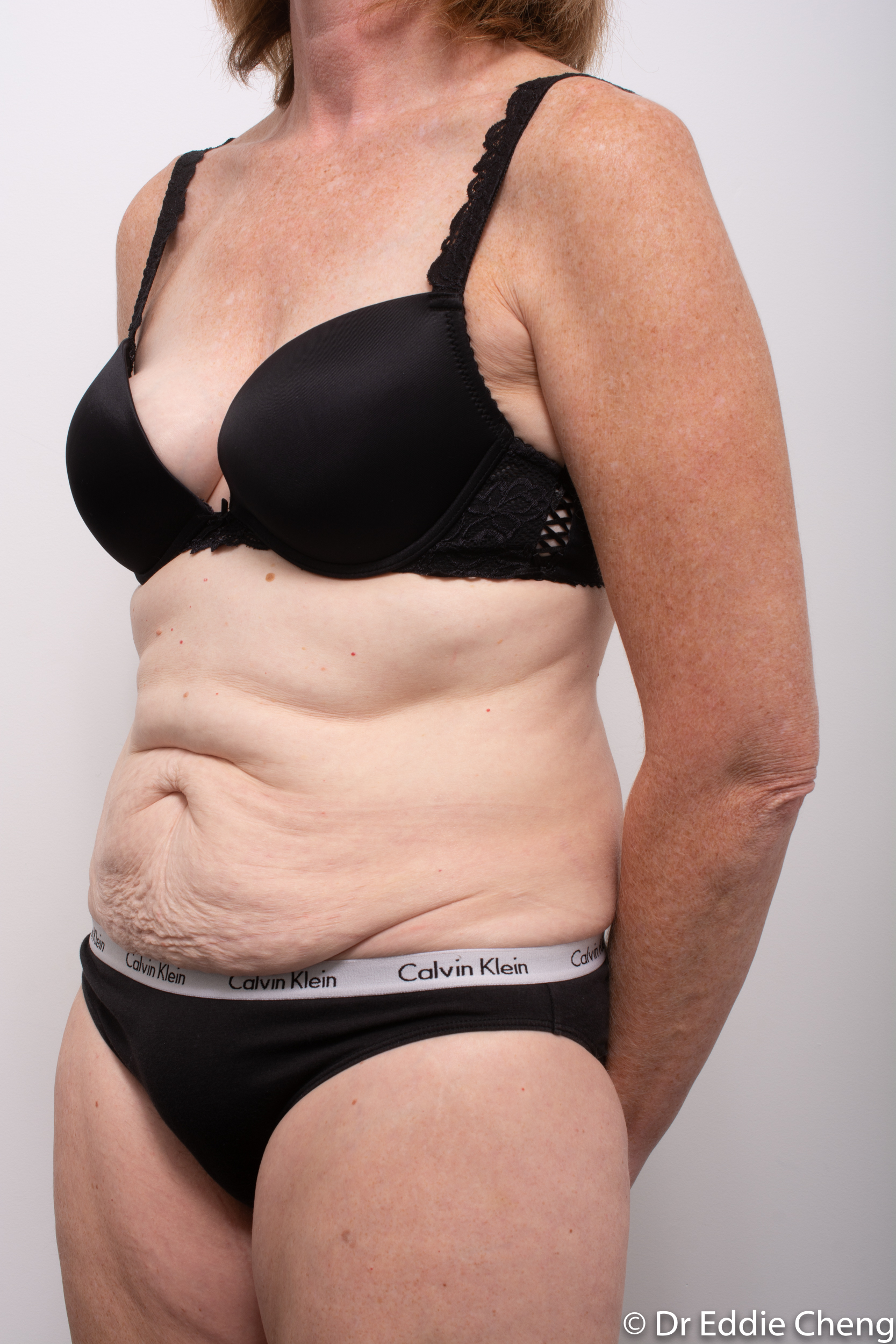 before and after abdominoplasty dr eddie cheng brisbane-4