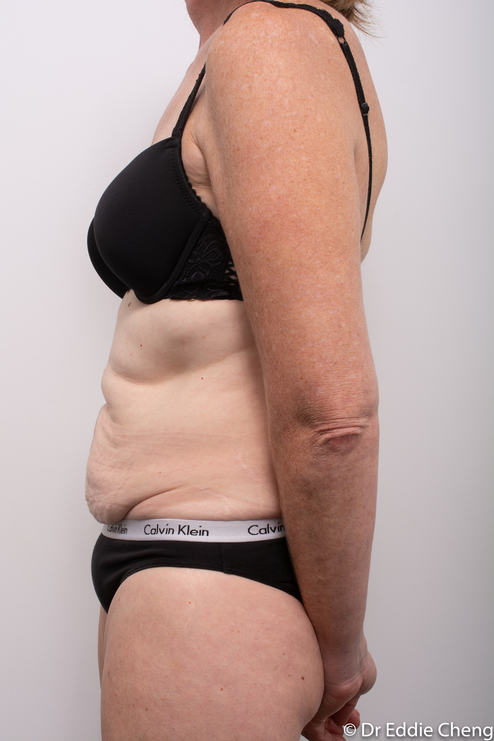 before and after abdominoplasty dr eddie cheng brisbane-5