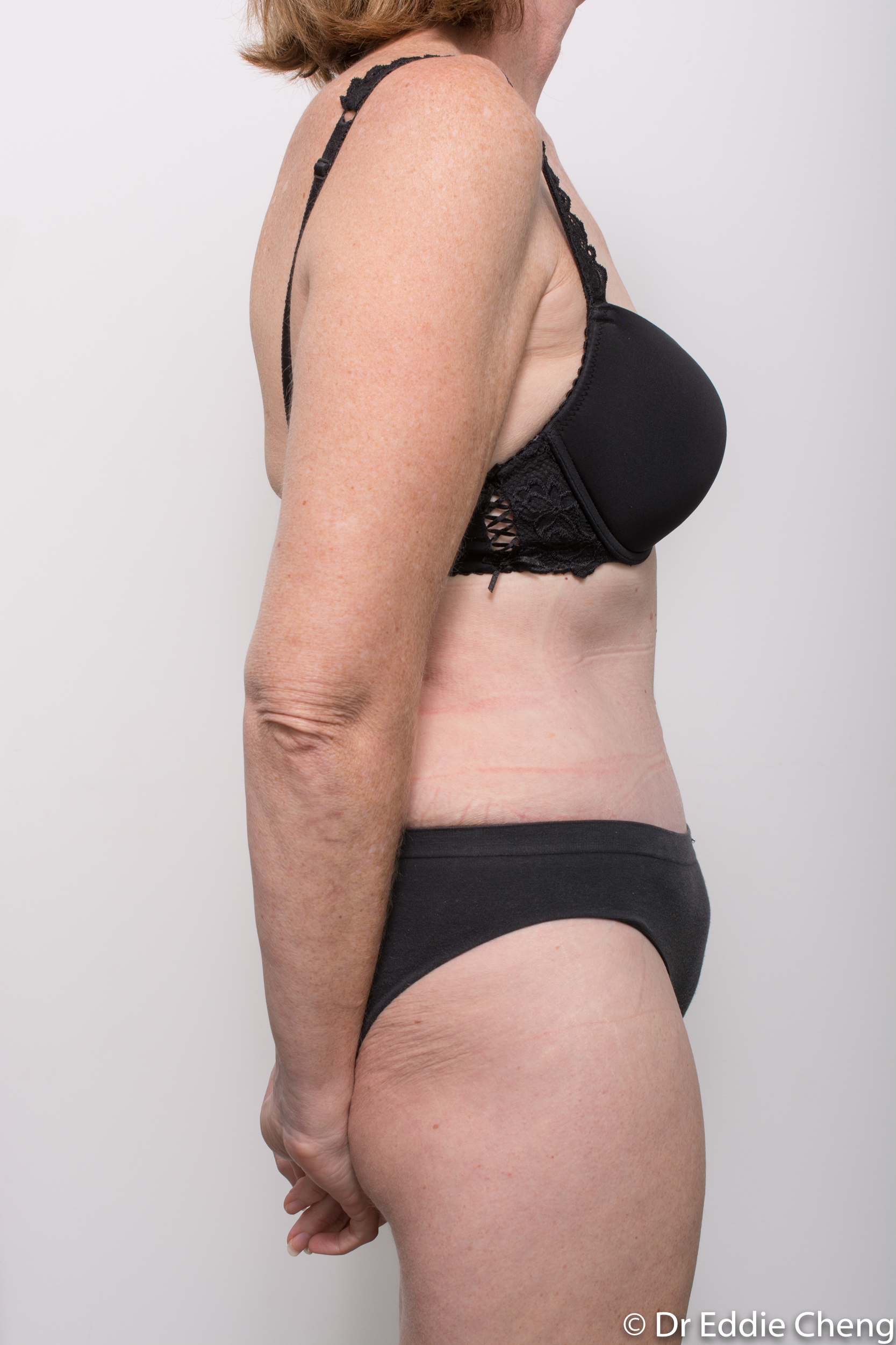 before and after abdominoplasty dr eddie cheng brisbane-6