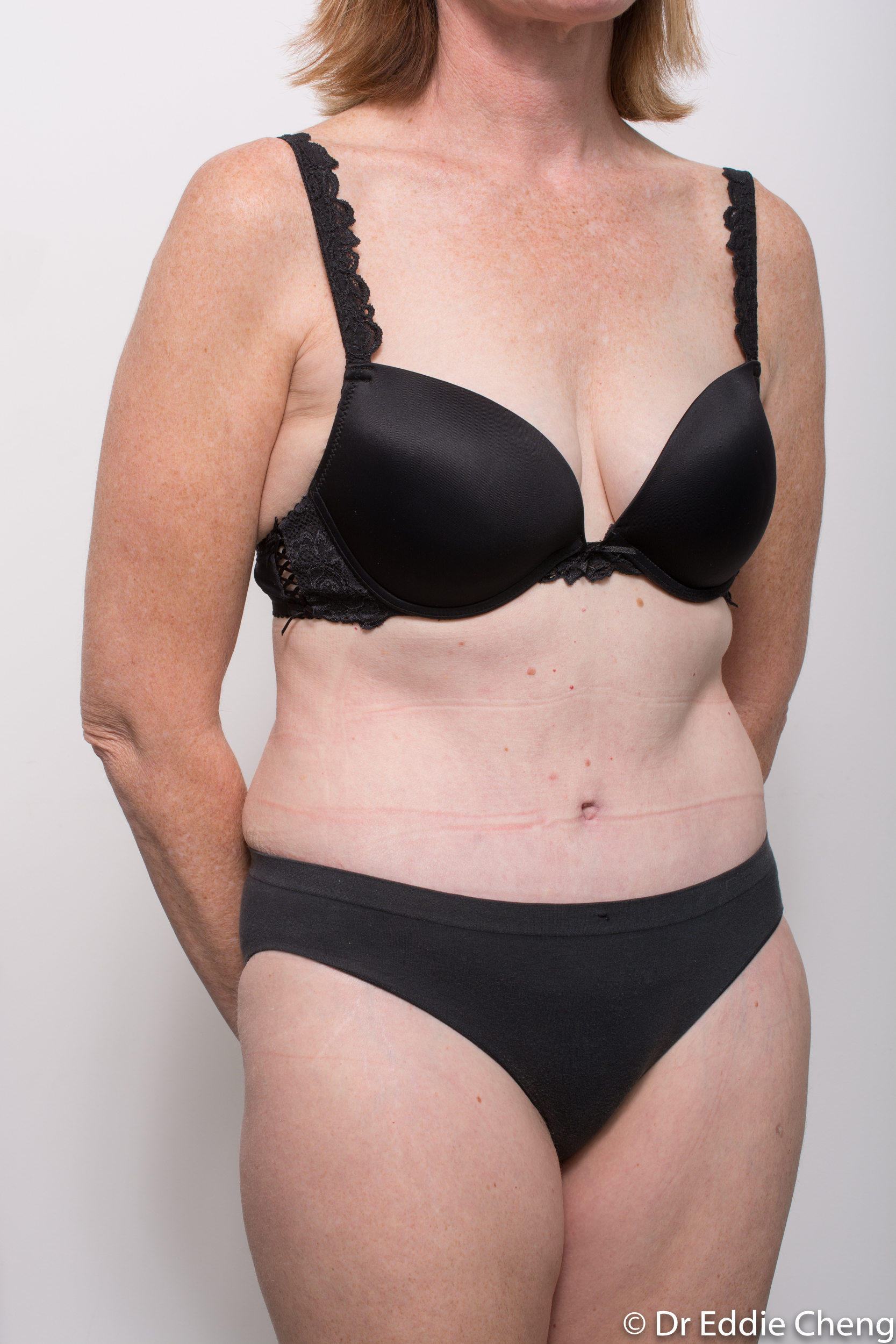 before and after abdominoplasty dr eddie cheng brisbane-7