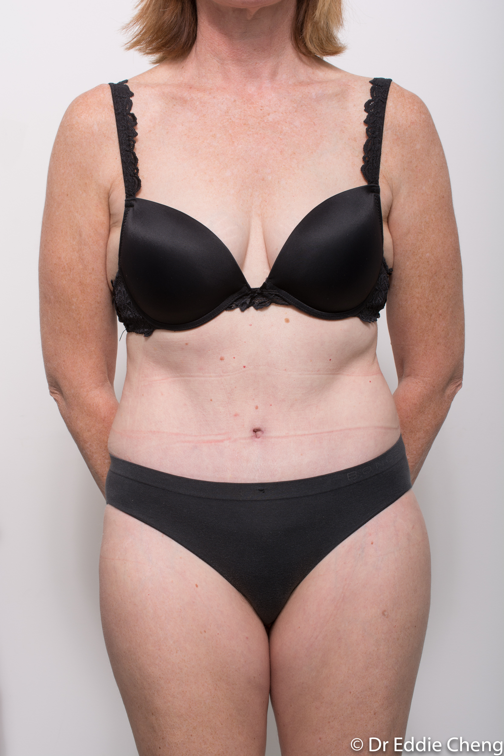 before and after abdominoplasty dr eddie cheng brisbane-8