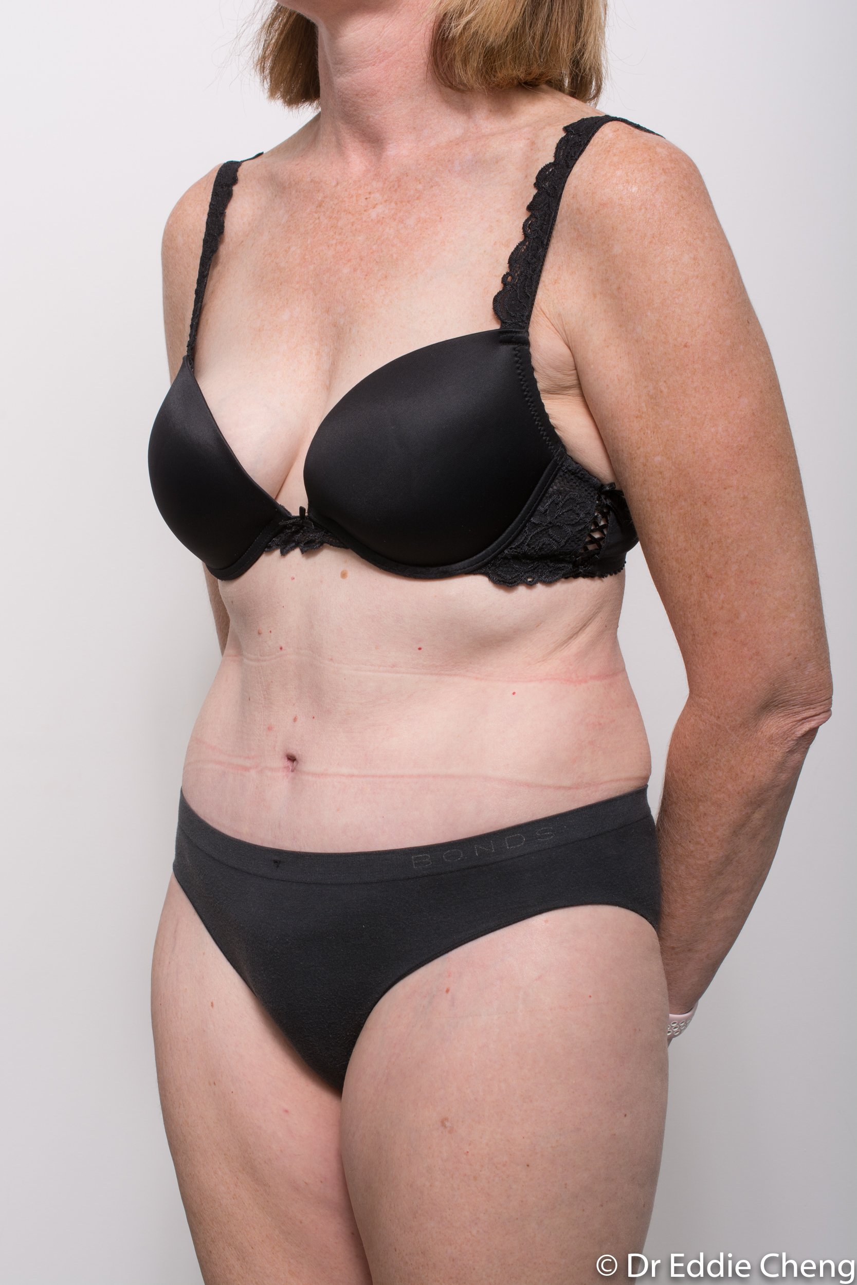 before and after abdominoplasty dr eddie cheng brisbane-9