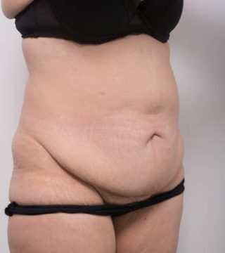 Abdominoplasty