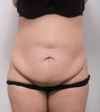 Abdominoplasty