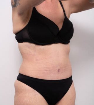 Abdominoplasty