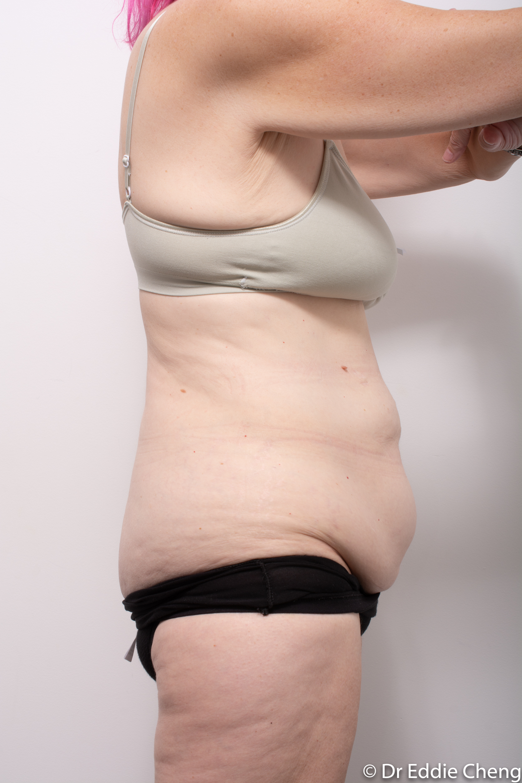 body lift brisbane dr eddie cheng weightloss pre and post op -1