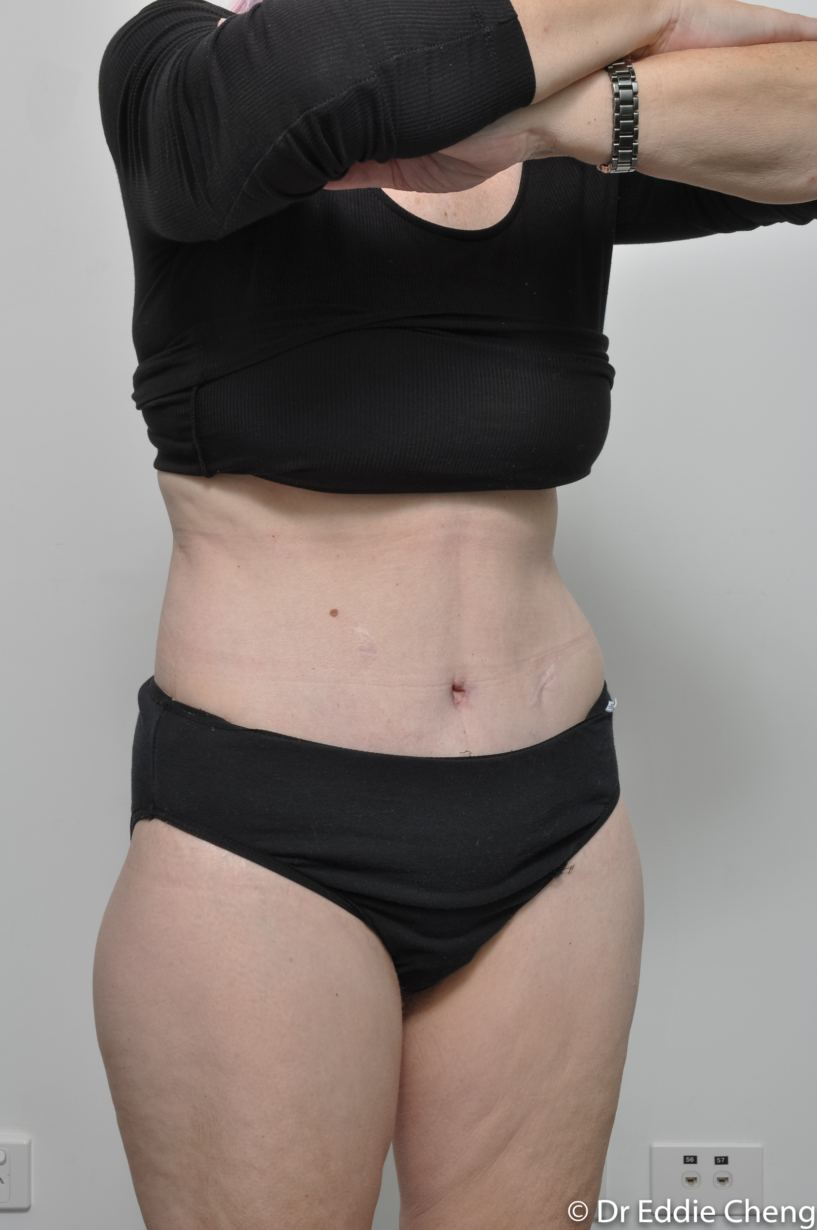 body lift brisbane dr eddie cheng weightloss pre and post op -12