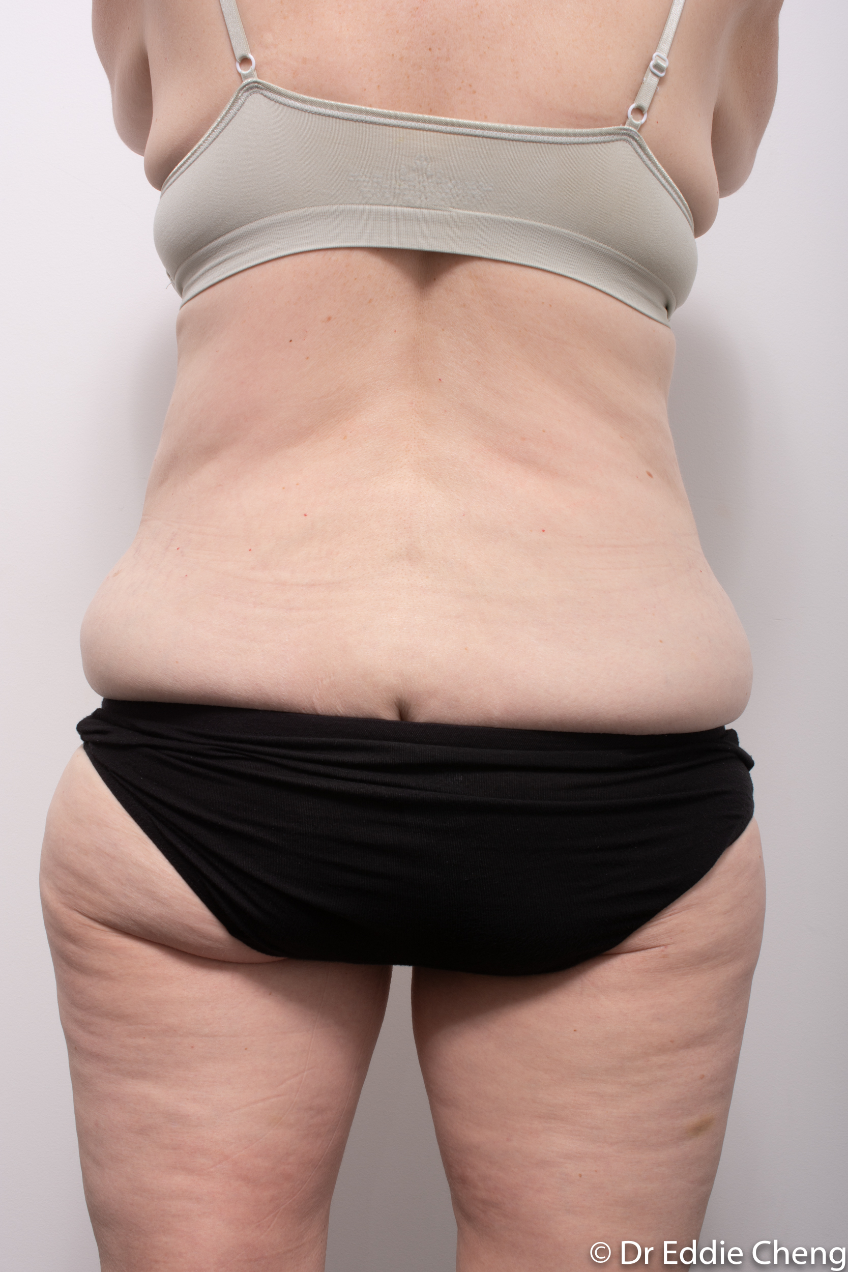 body lift brisbane dr eddie cheng weightloss pre and post op -6