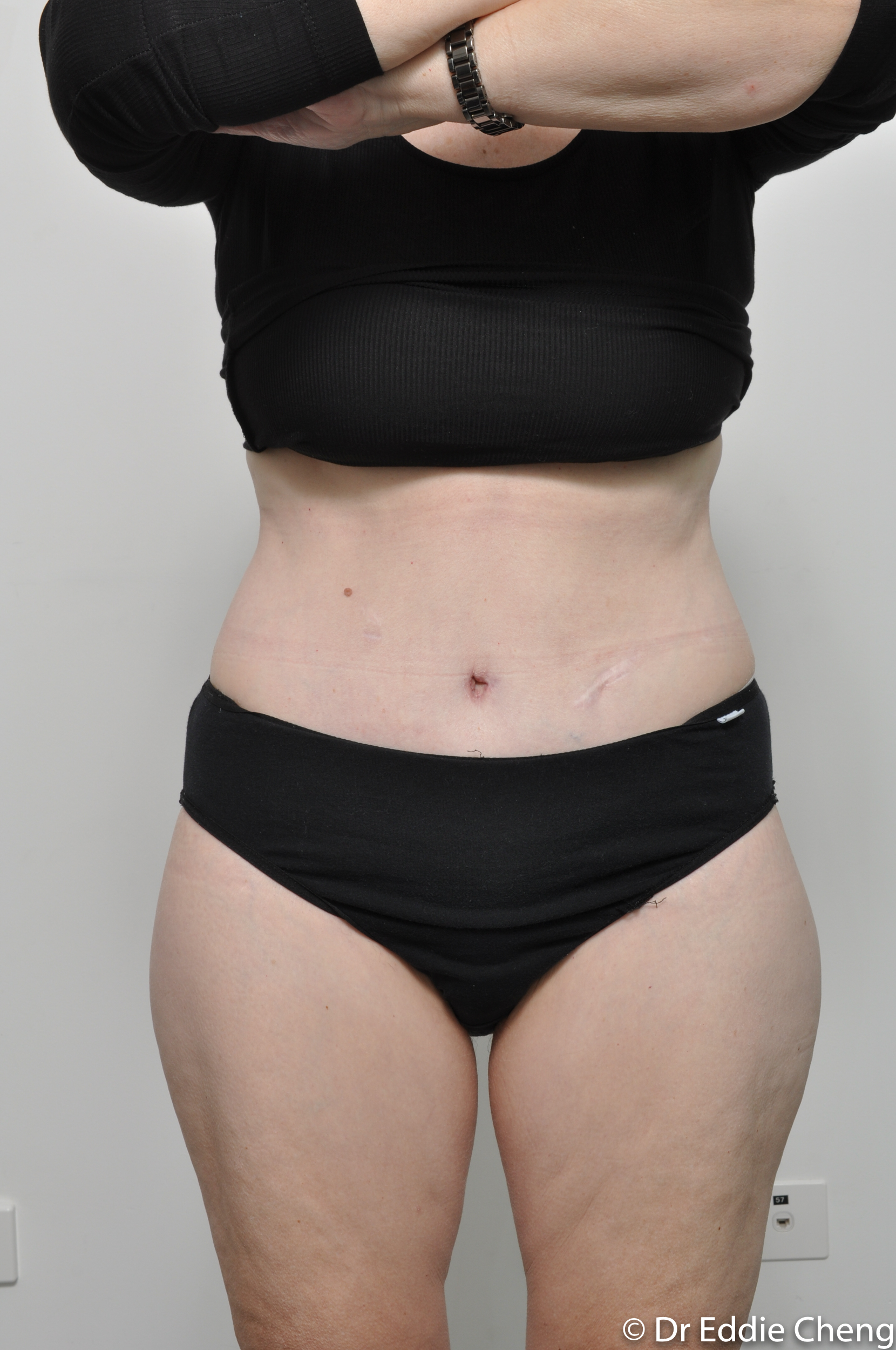 body lift brisbane dr eddie cheng weightloss pre and post op -7