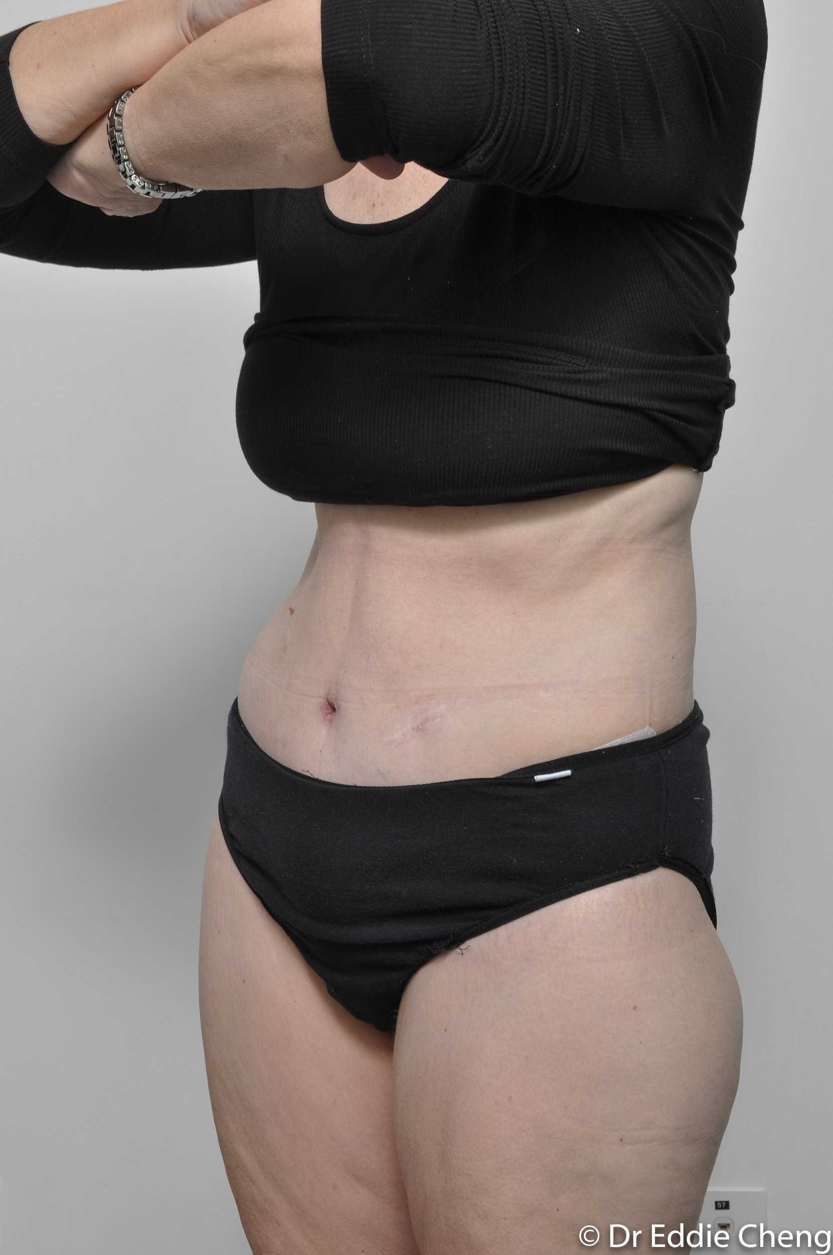 body lift brisbane dr eddie cheng weightloss pre and post op -8