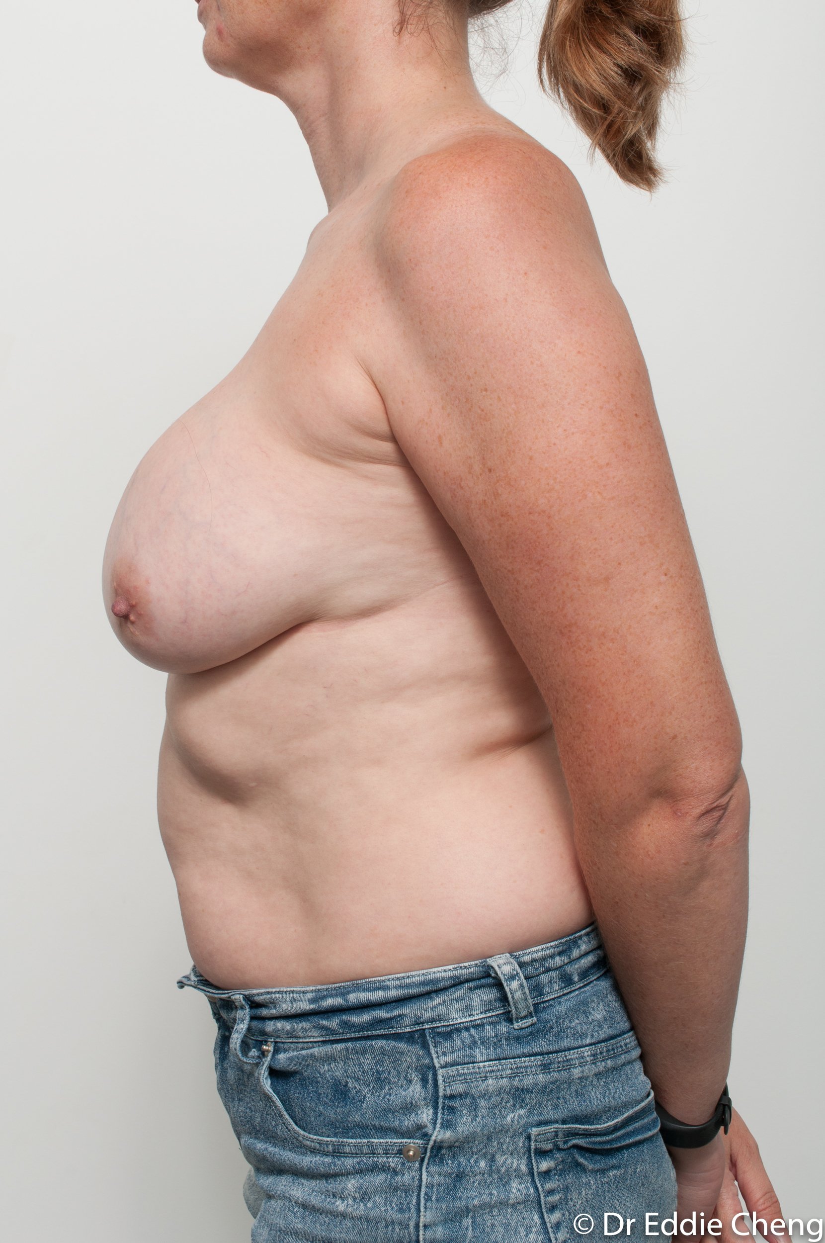 breast implant removal or explant and breast lift by dr eddie cheng brisbane-3