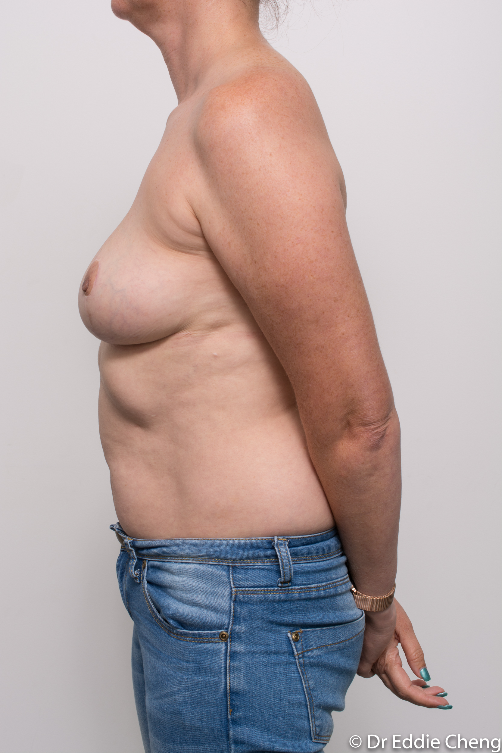 breast implant removal or explant and breast lift by dr eddie cheng brisbane-8