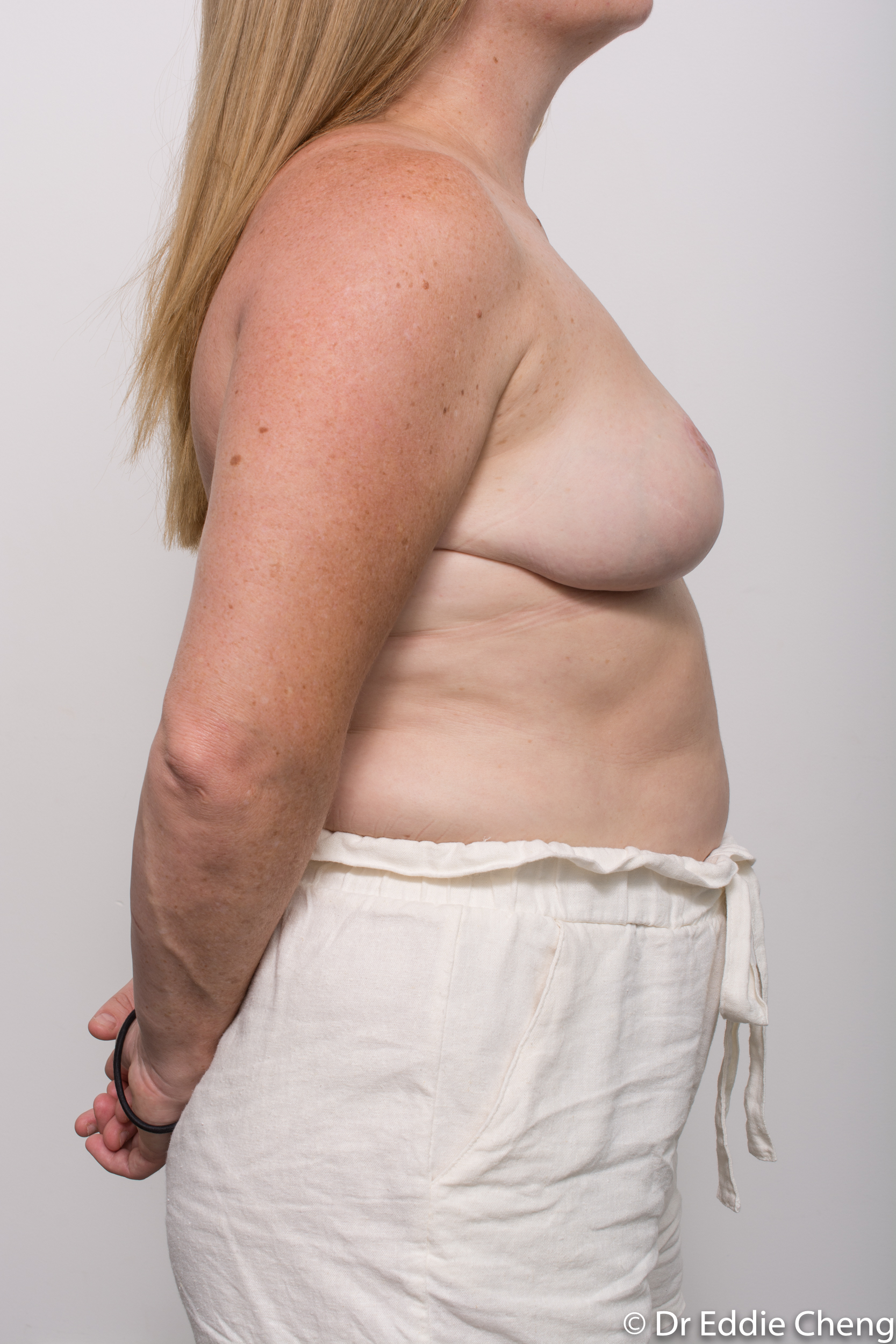 breast reduction dr eddie cheng brisbane surgeon pre and post operative images-9