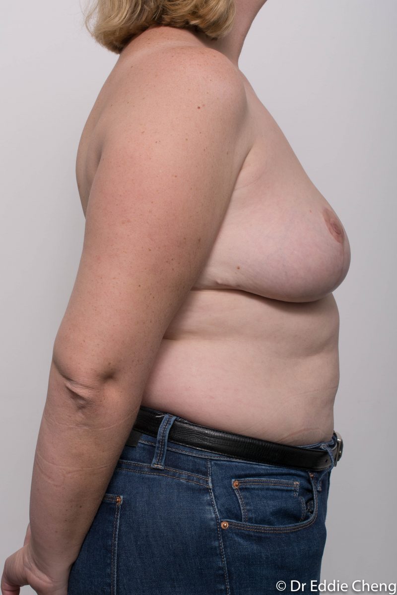 breast-reduction-post-op-4-months-10-800x1200