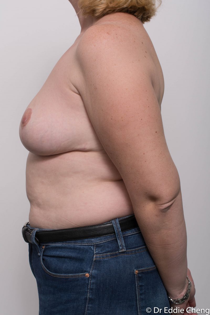 breast-reduction-post-op-4-months-8-800x1200