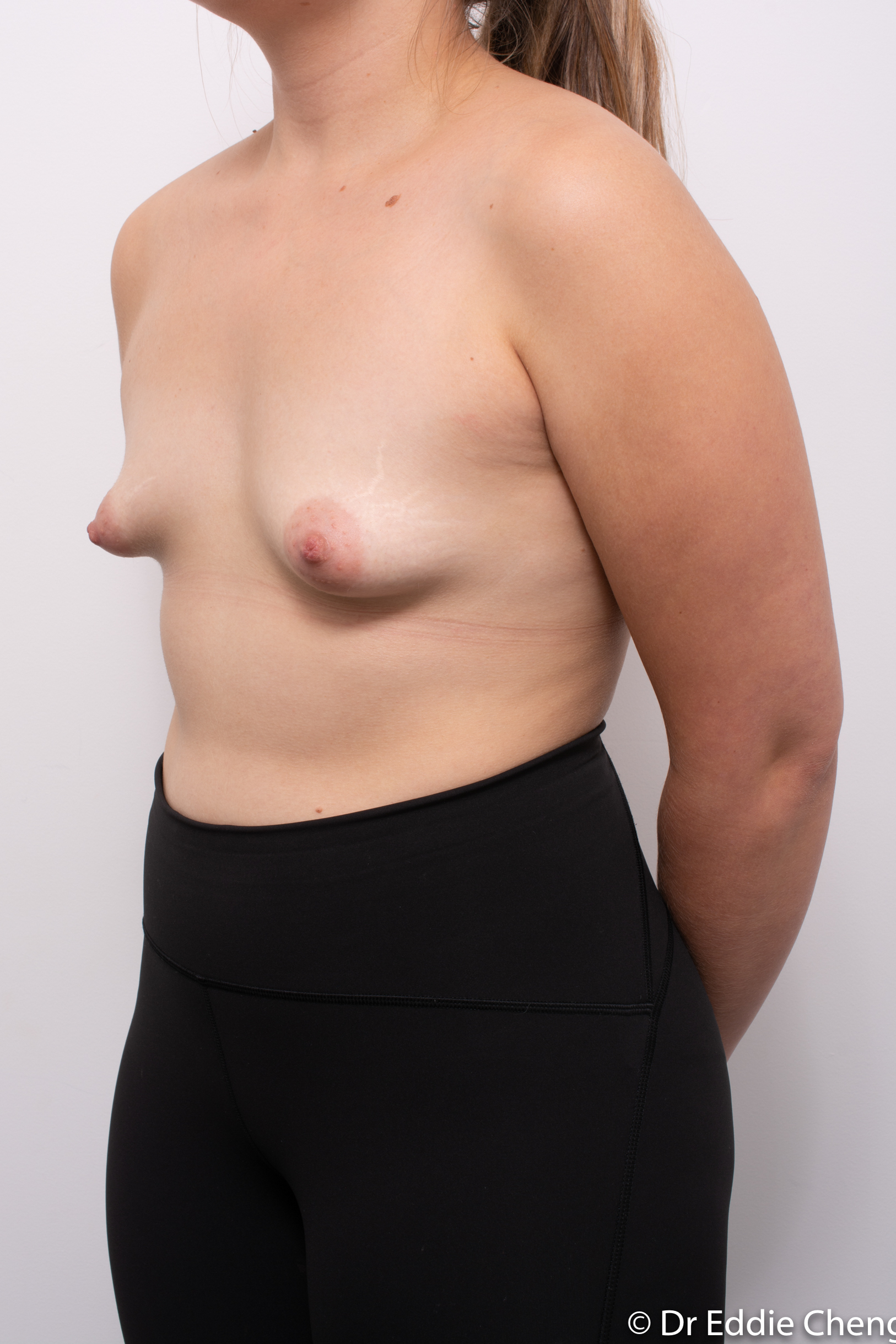 correction of tuberous breasts (7 of 7)